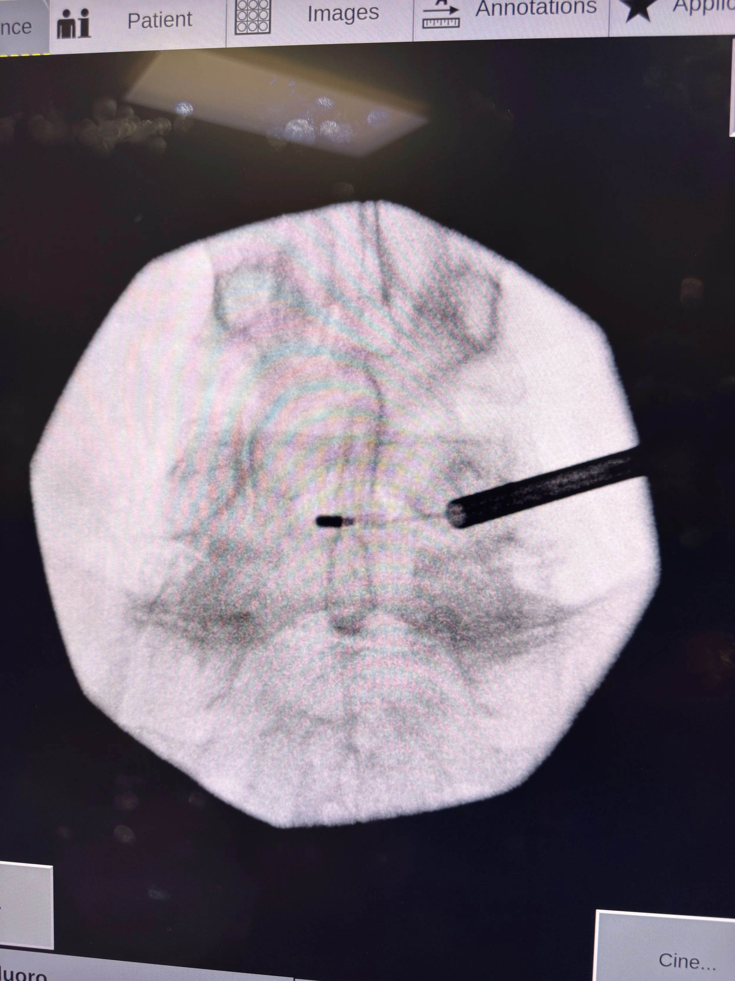 What is Basivertebral Nerve Ablation