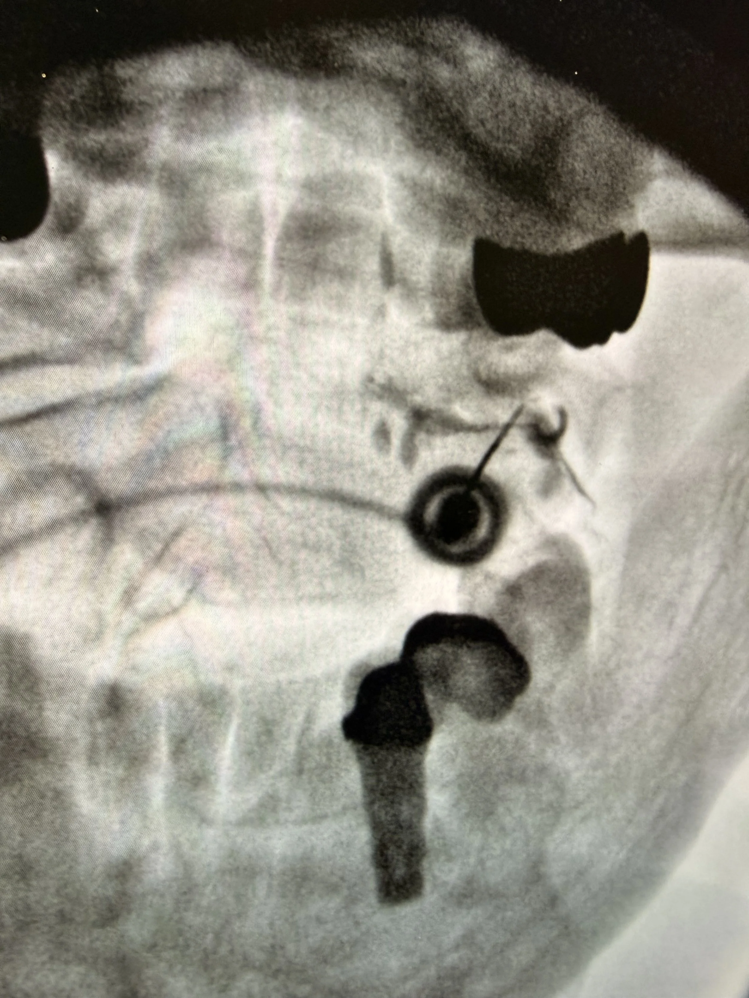 Facet Joint Injections