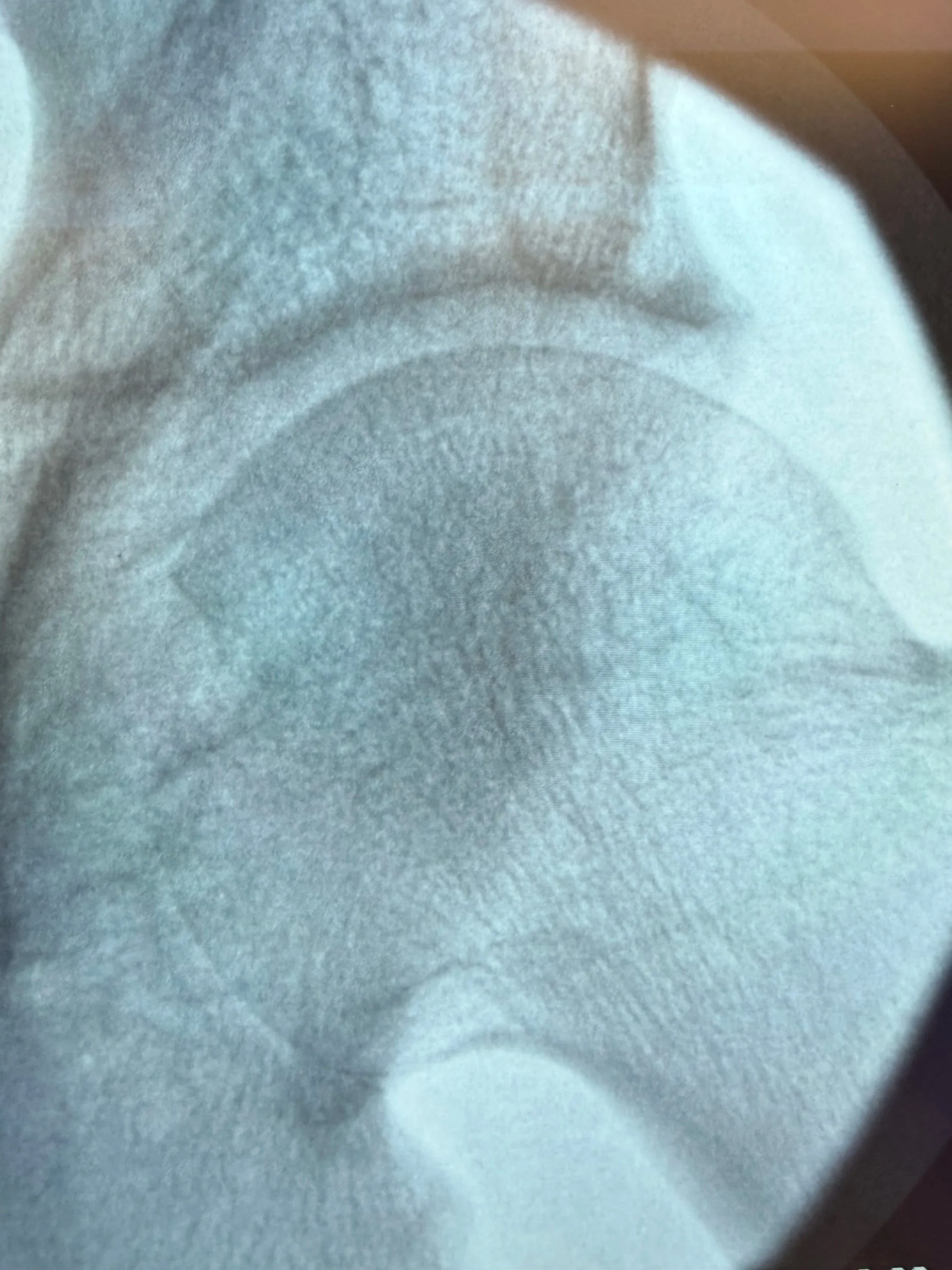 Arthritis - A Disease of “Too Many Birthdays”