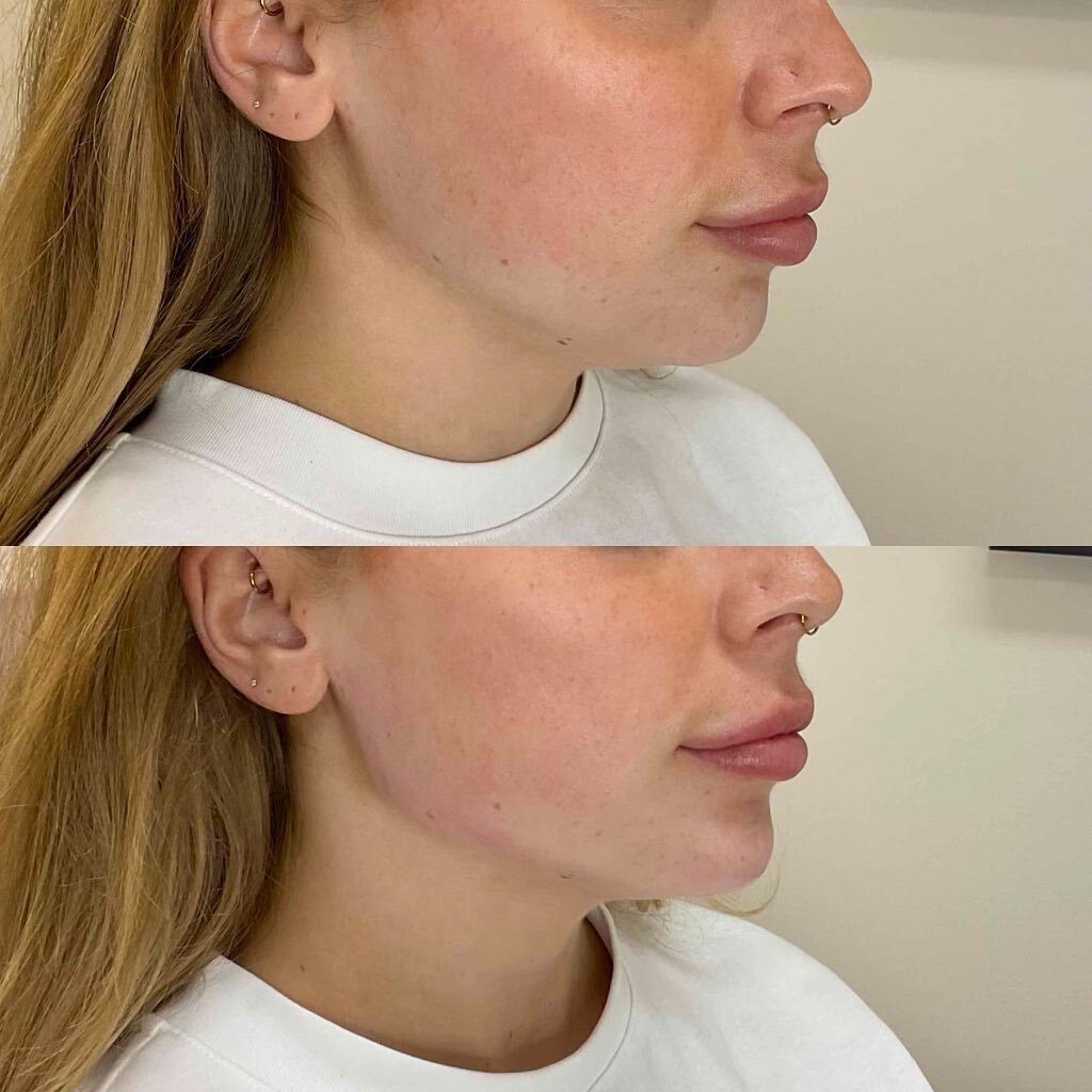 We had a new patient experiencing jaw augmentation today with Keely! 

This procedure has sharpened her jawline, improved side profile and balanced her lips, nose and chin. 

#jaw #jawaugmentation #cosmeticinjectables #cosmeticnurse #nurse #aesthetic