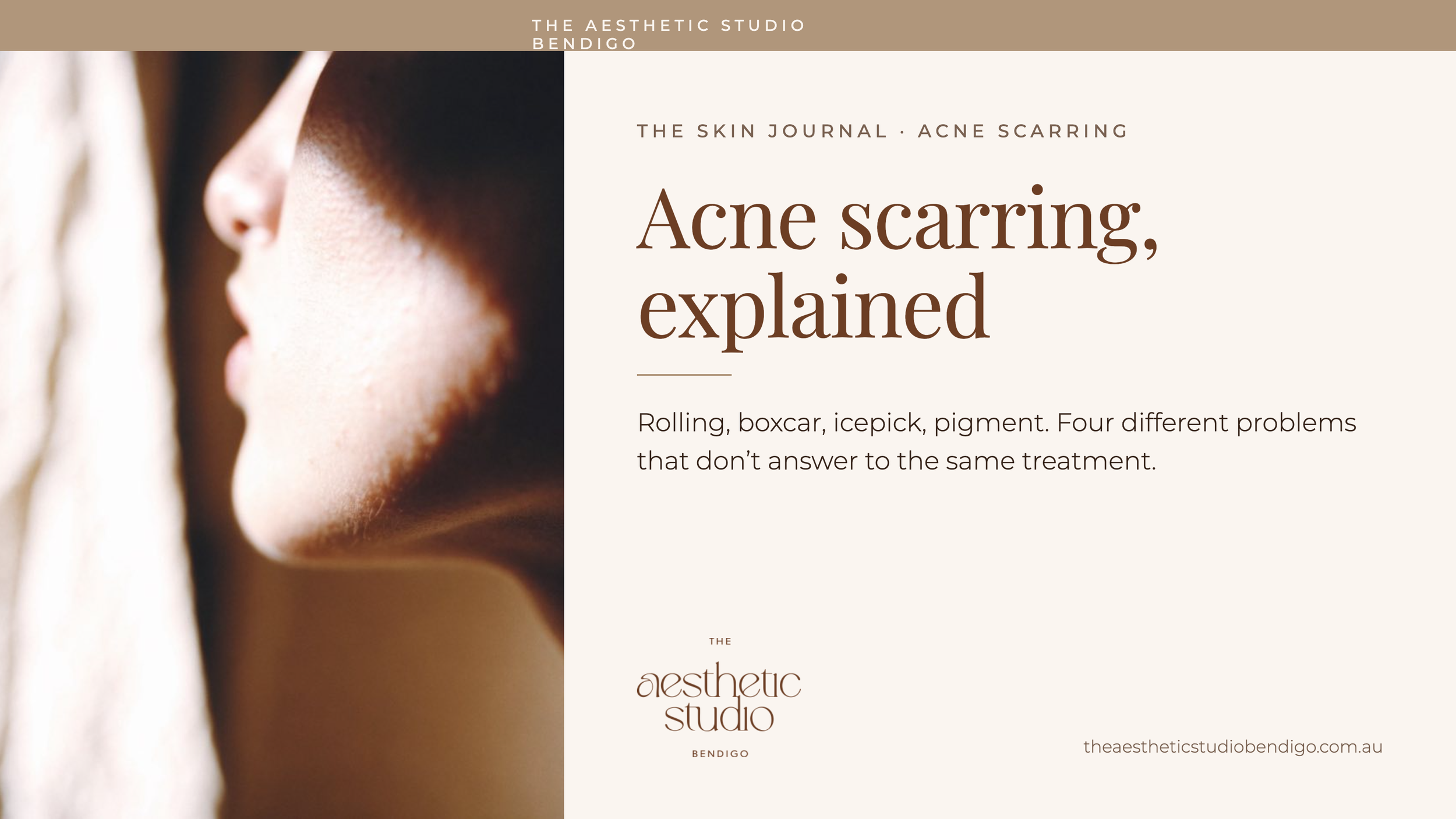 Acne Scarring Explained