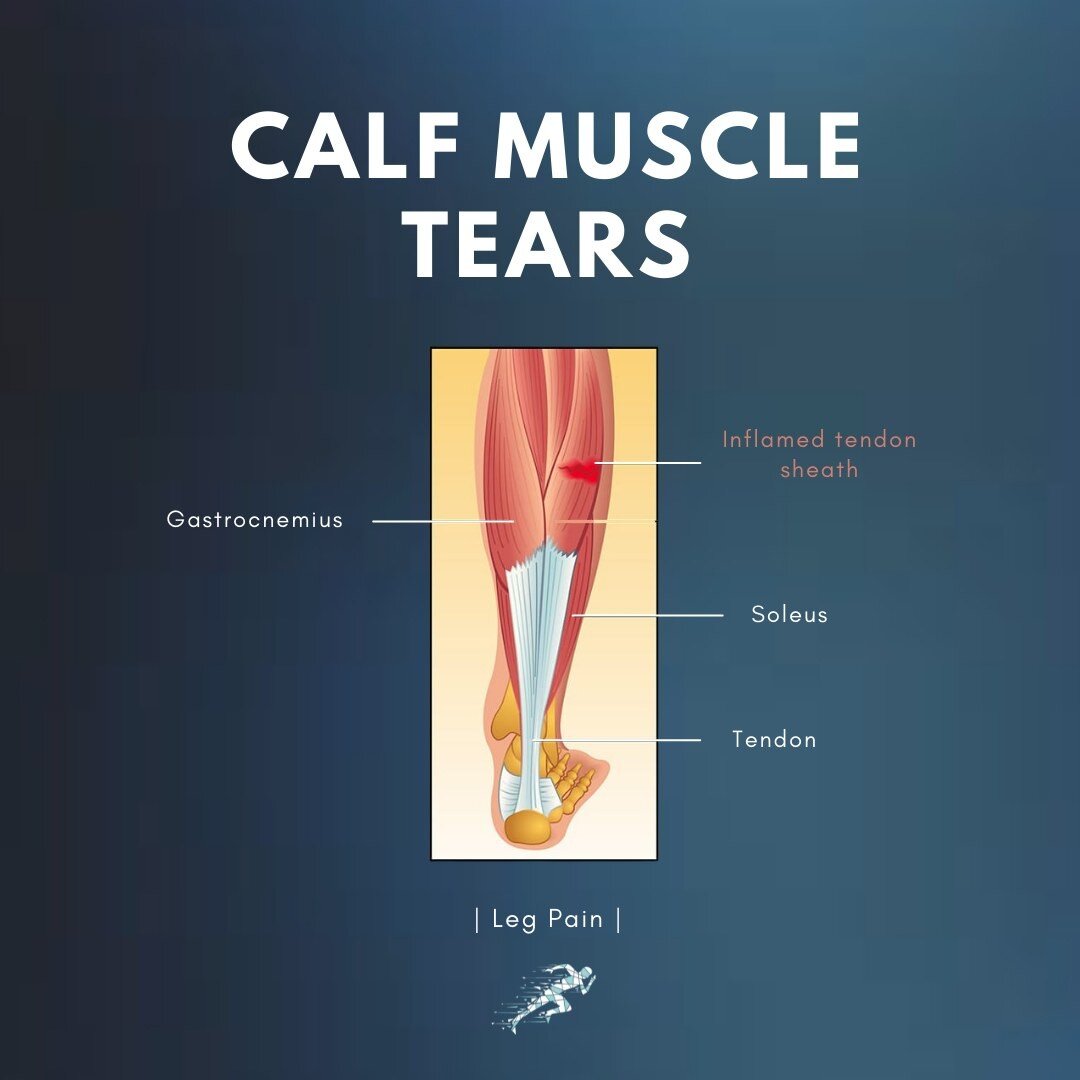 🧠 Our calf muscles are extremely strong, and they help us propel forwards and upwards. They can be prone to tearing due to the high demands the body requires of them, particularly with athletic activity.

🏃 Feeling a pull/strain in the calf area is