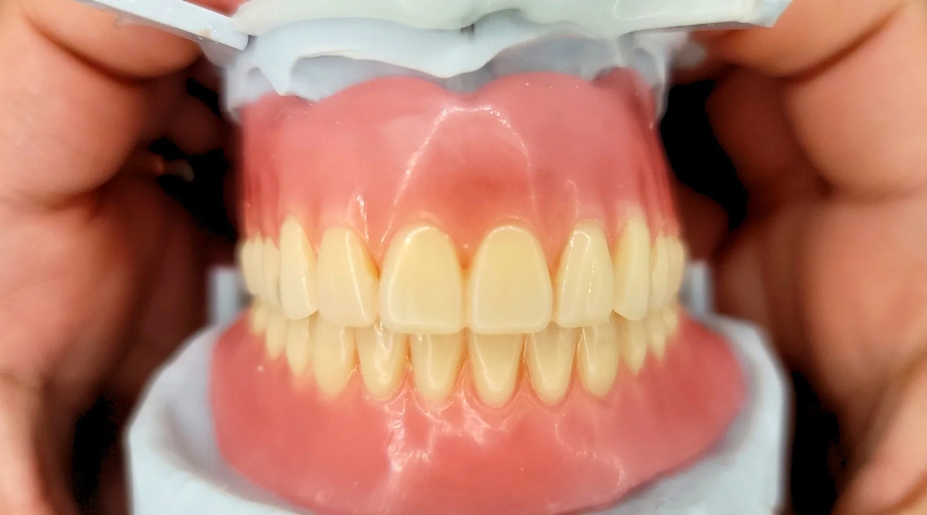 Close-up of a dental model showing upper and lower teeth with pink gums, held open by hands