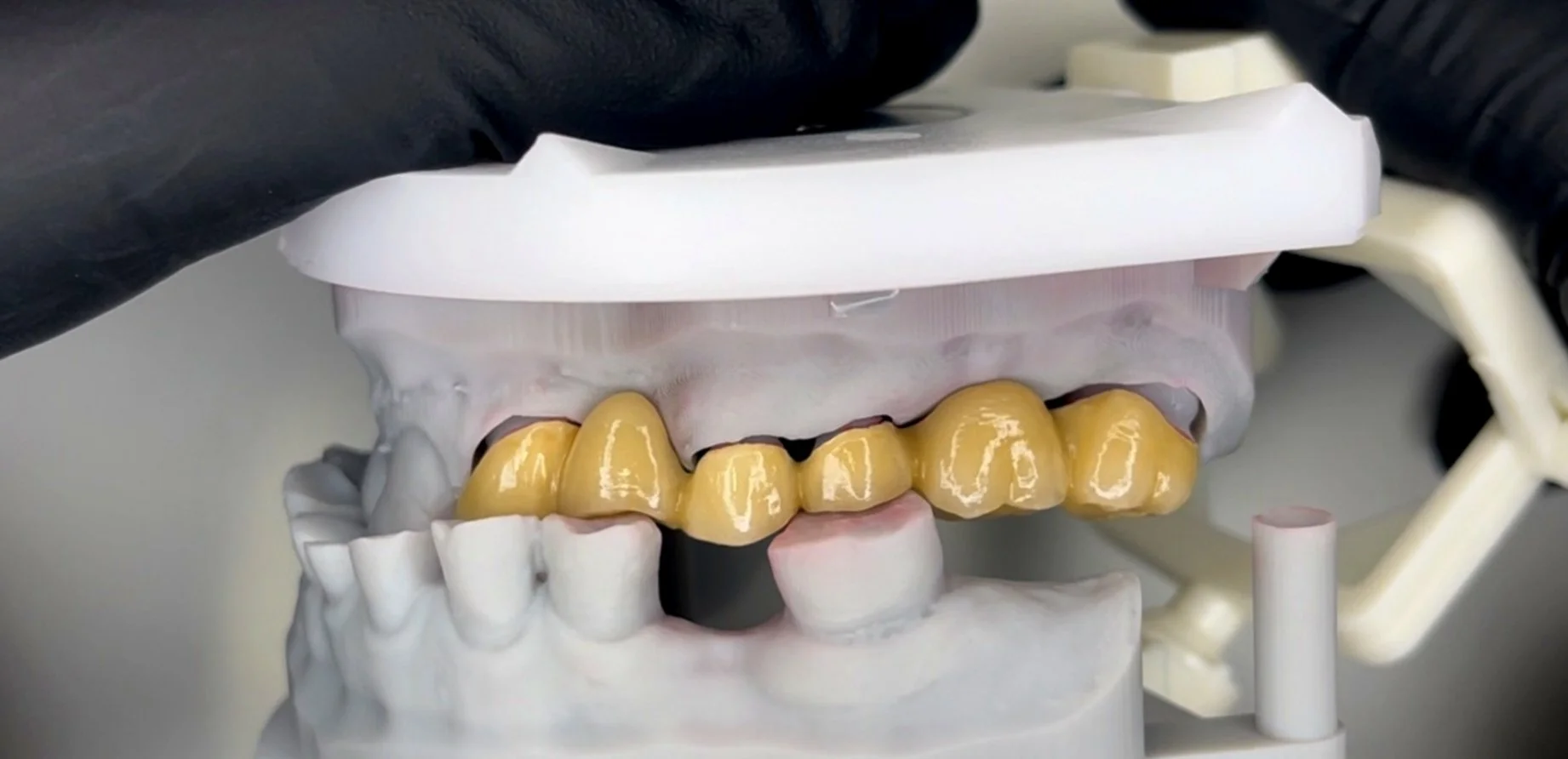 A dental model of teeth with gold crowns or bridges on the upper teeth, held in a dental articulator or jaw simulator, with a person wearing black gloves handling it.