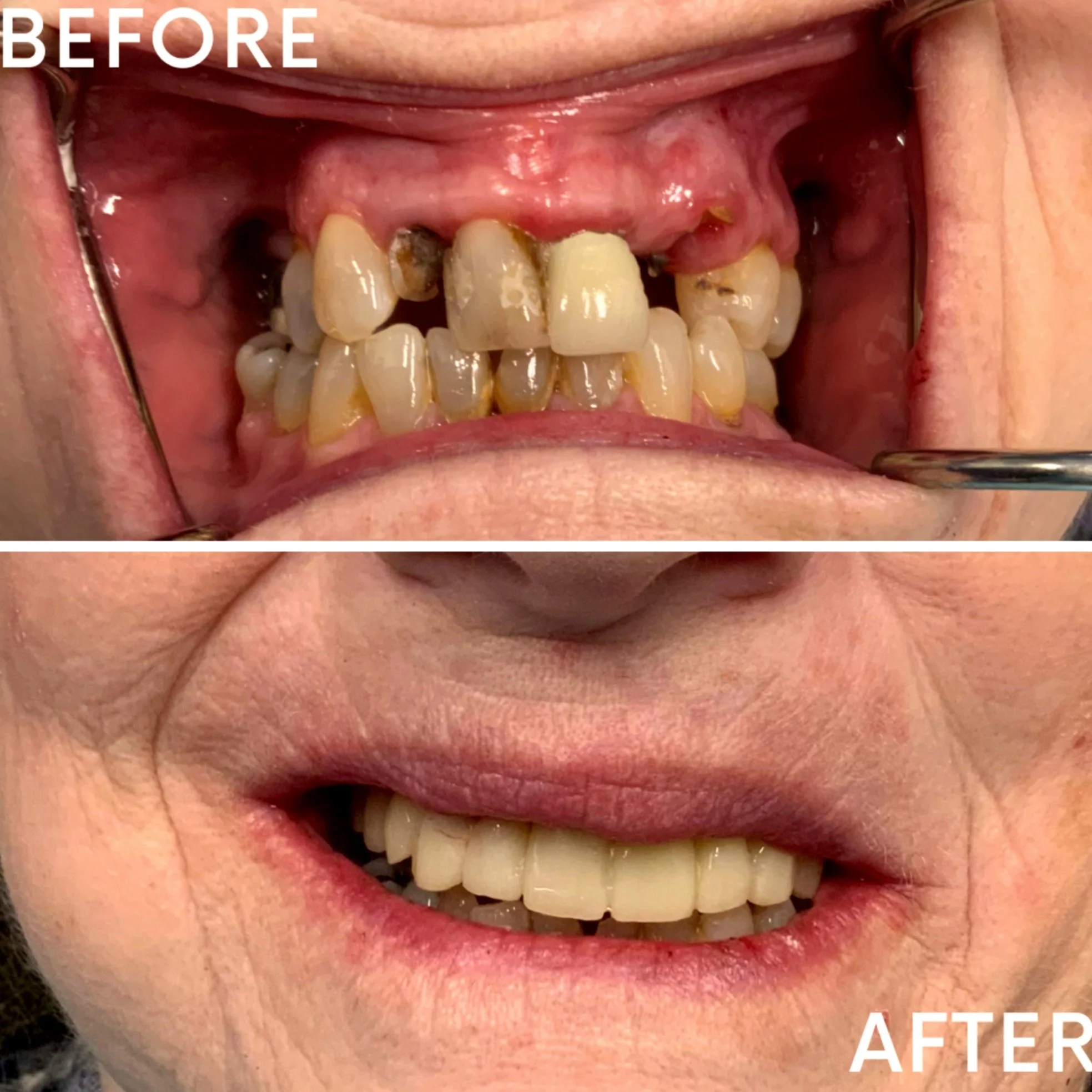 Comparison image showing stained, crooked, and decayed teeth before dental treatment, and straight, clean, restored teeth after dental work.