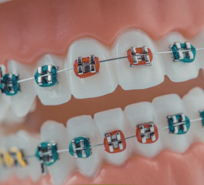 Close-up of teeth with colored braces on upper and lower teeth.
