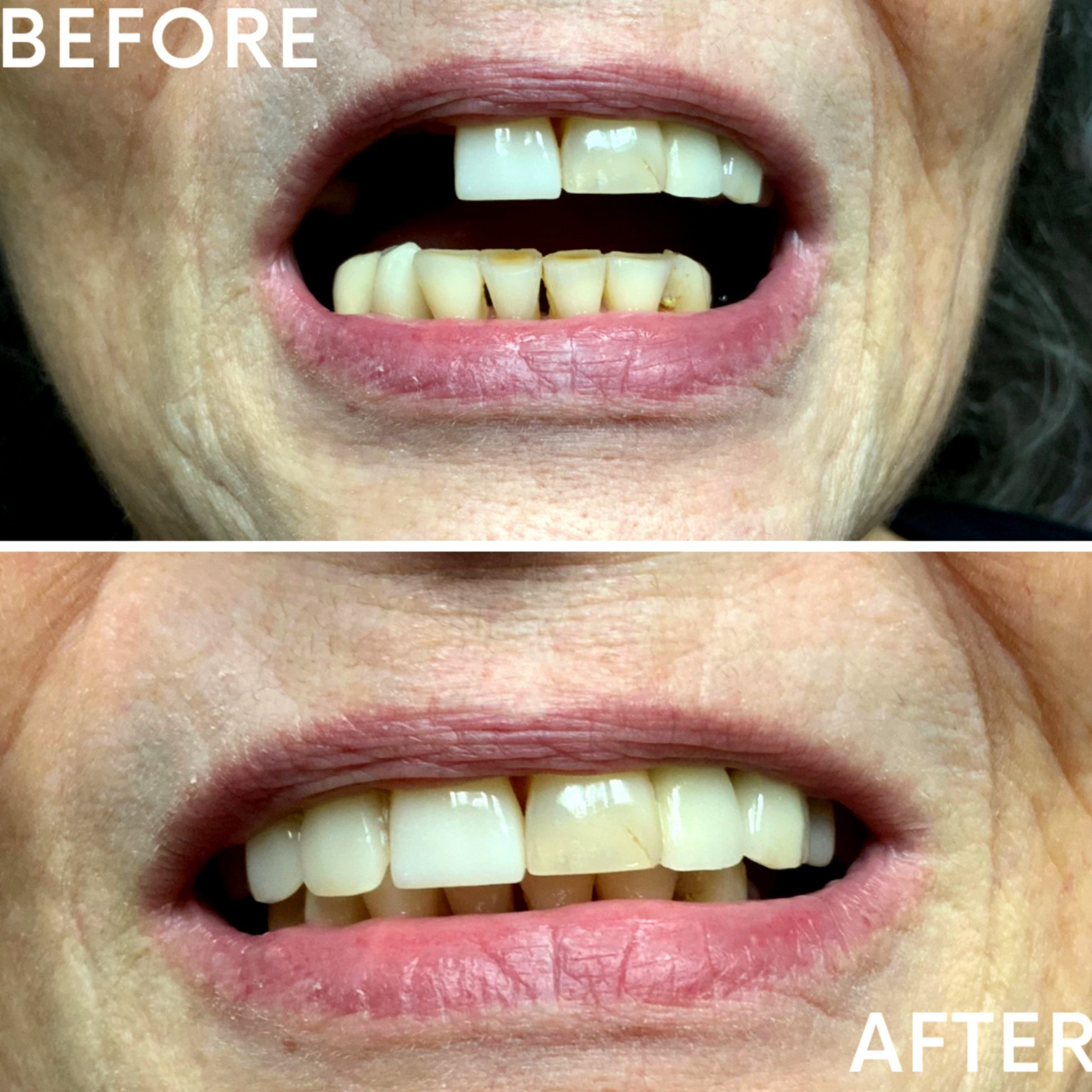 Comparison of a person's teeth before and after dental work. The 'before' image shows stained, chipped, and misaligned teeth, while the 'after' image shows cleaner, whiter, and better aligned teeth.
