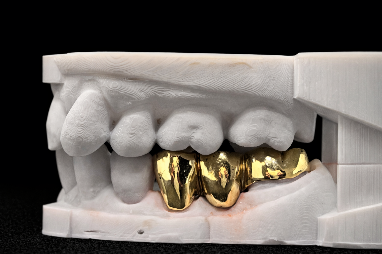 A white dental model showing teeth with gold dental crowns on the lower front teeth.
