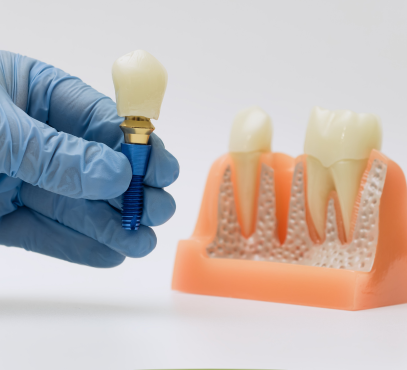 Dental model with a dental implant and a hand holding a dental crown, showing dental restoration procedures.
