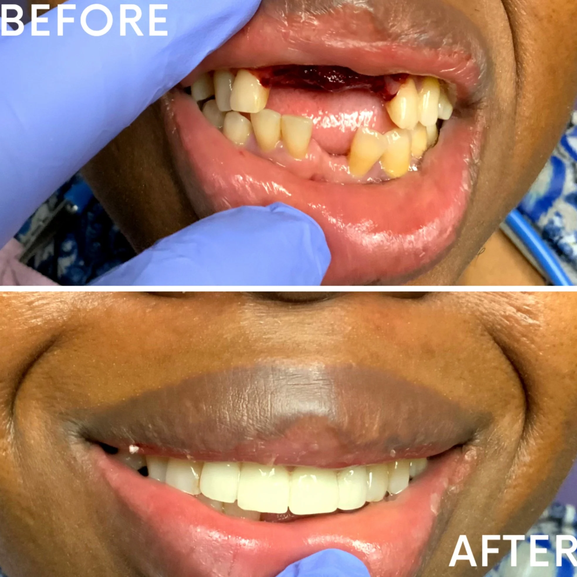 Close-up of a person's smile before and after dental treatment, showing improved teeth alignment and appearance.