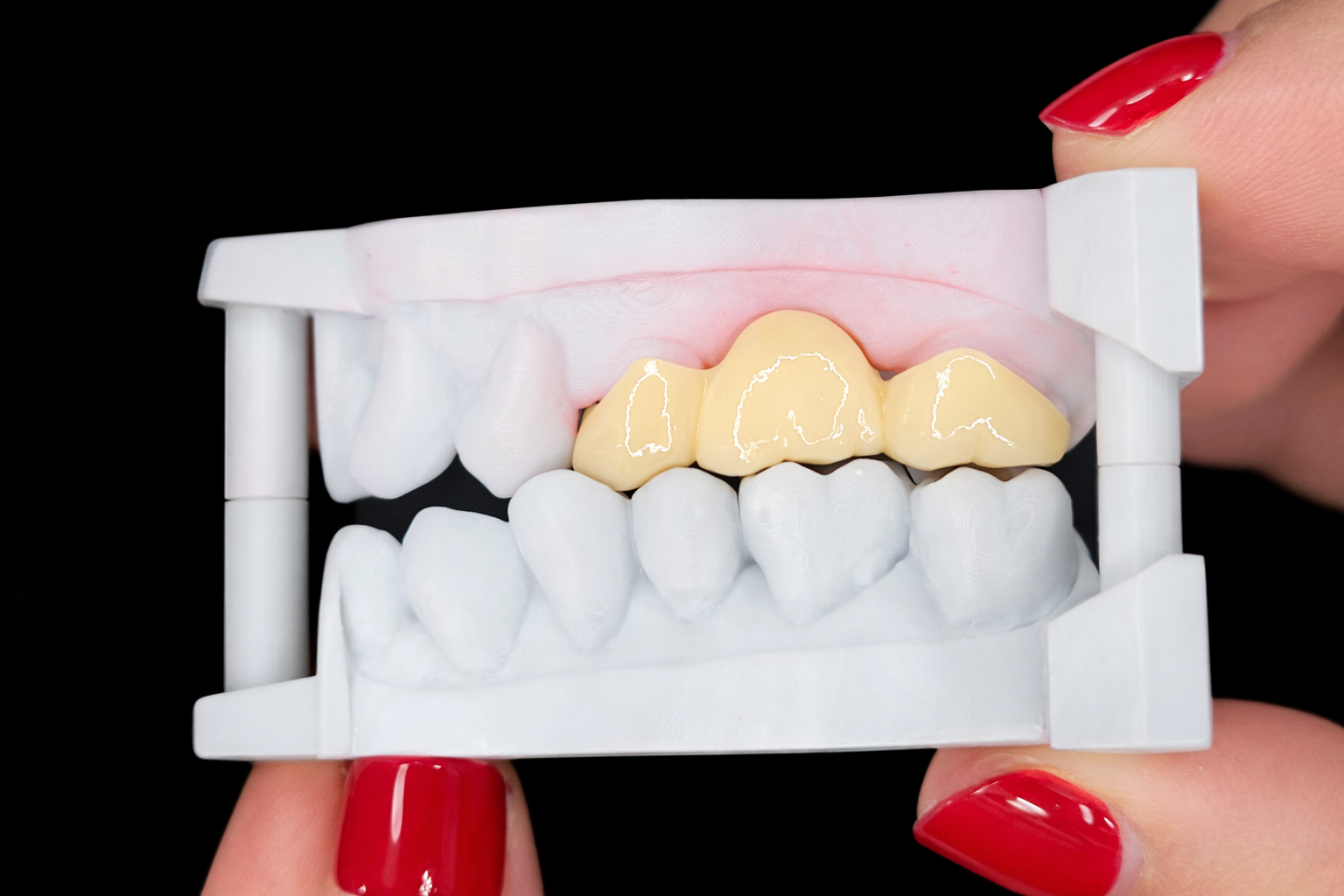A dental model showing the upper teeth with a yellow dental crown or veneer on three front teeth, held by fingers with red nail polish.