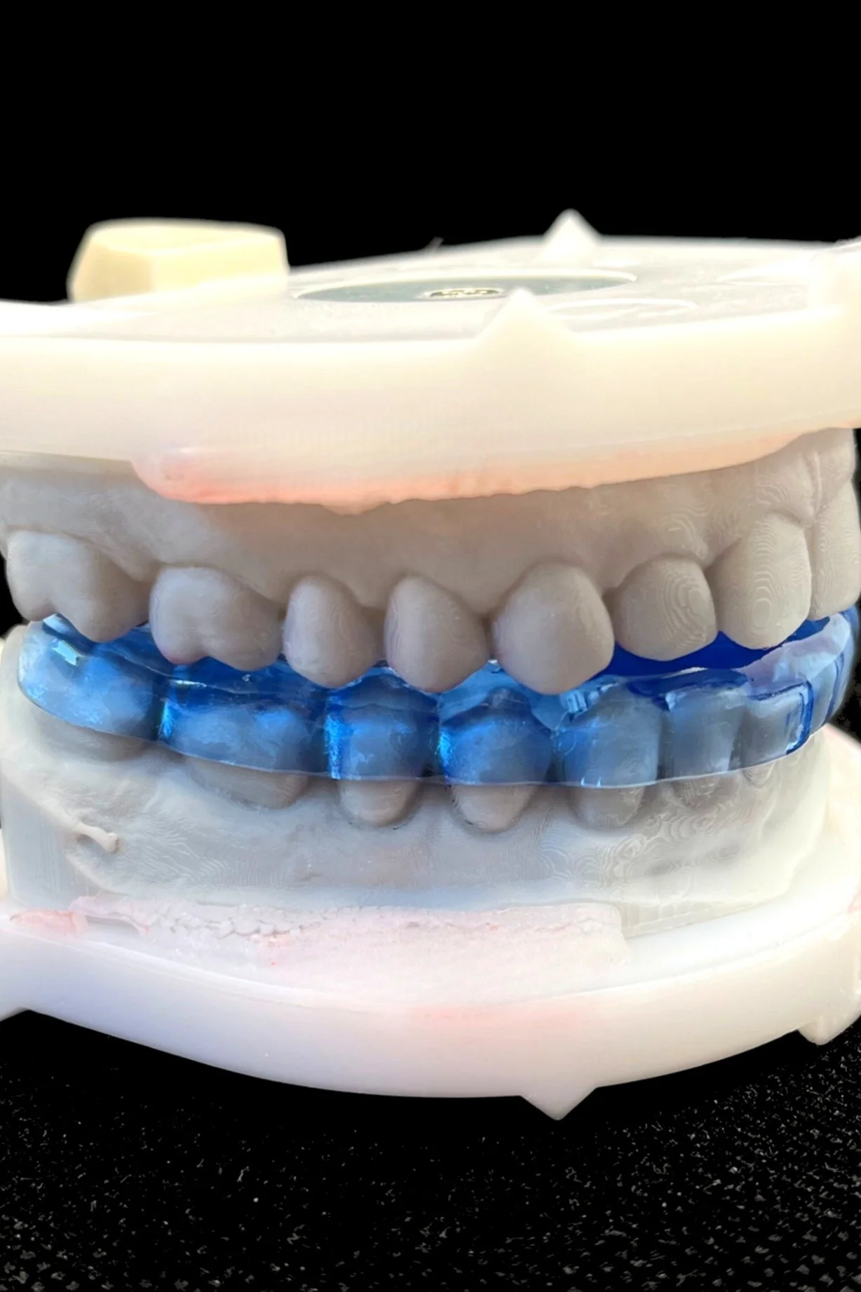 A dental model showing upper and lower teeth with a blue dental bite guard on the lower teeth.