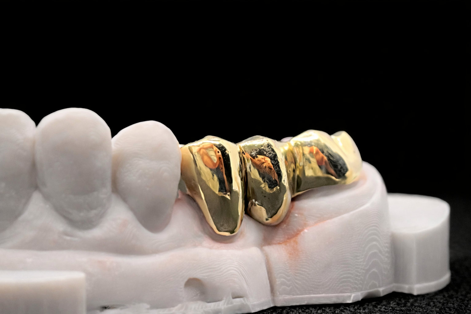 A dental model with a gold dental crown on one of the teeth, set against a black background.