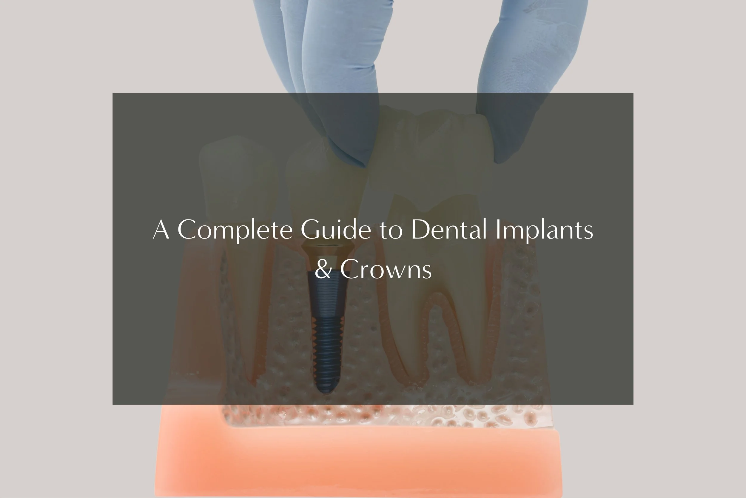 A Complete Guide to Dental Implants &amp; Crowns