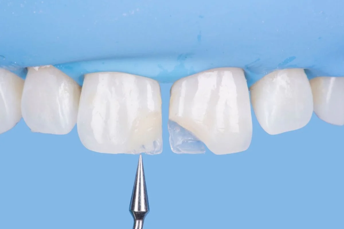 Composite Veneers Brisbane