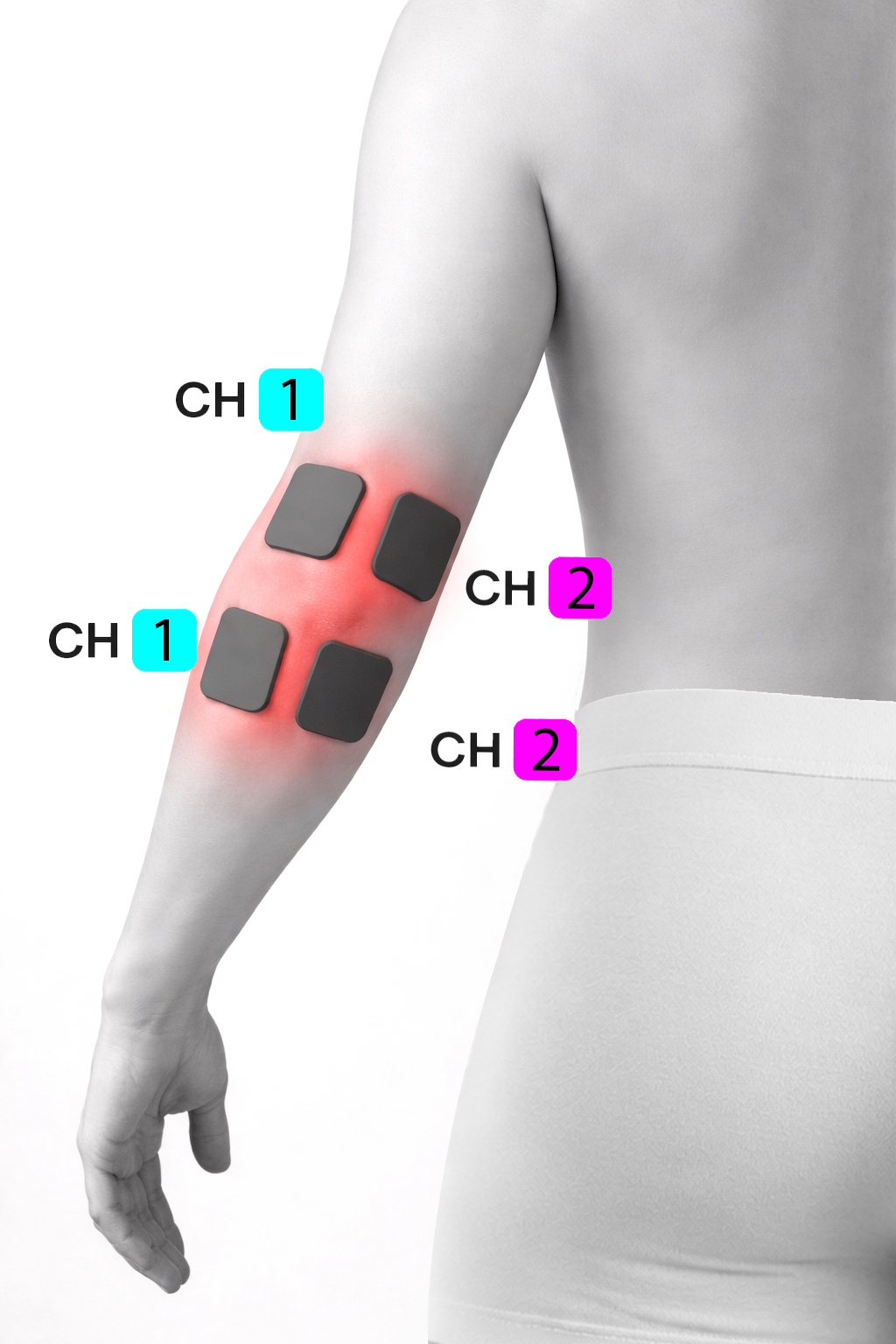 Chronic Pain Management Electrode Placement Examples