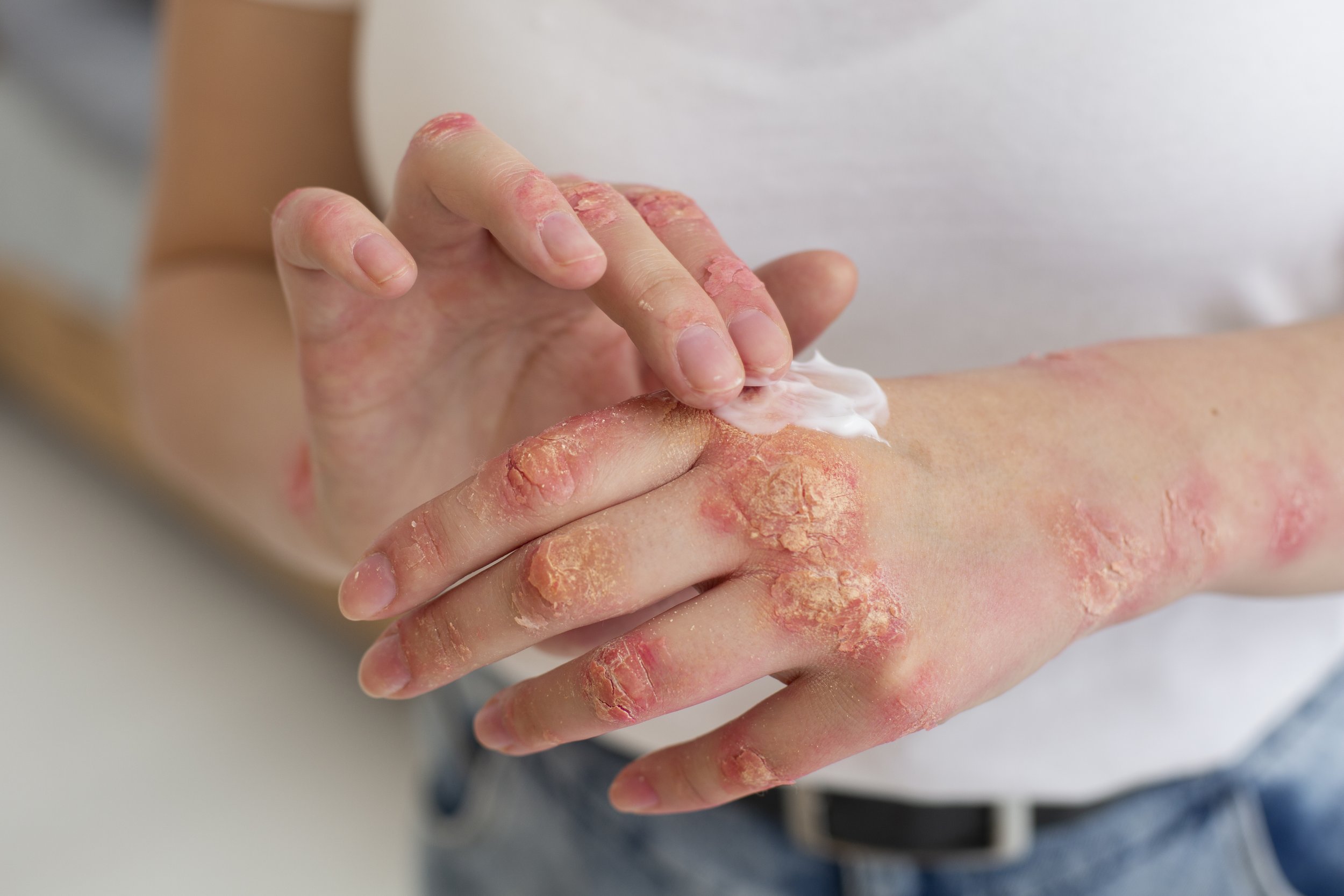 Fungal Infections in Humid Weather: Causes, Symptoms &amp; Prevention