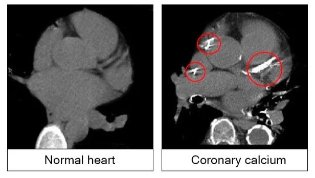 Comparison between a normal heart and a heart with coronary calcium shown in CT scans, with the calcium deposits highlighted in red on the right image.