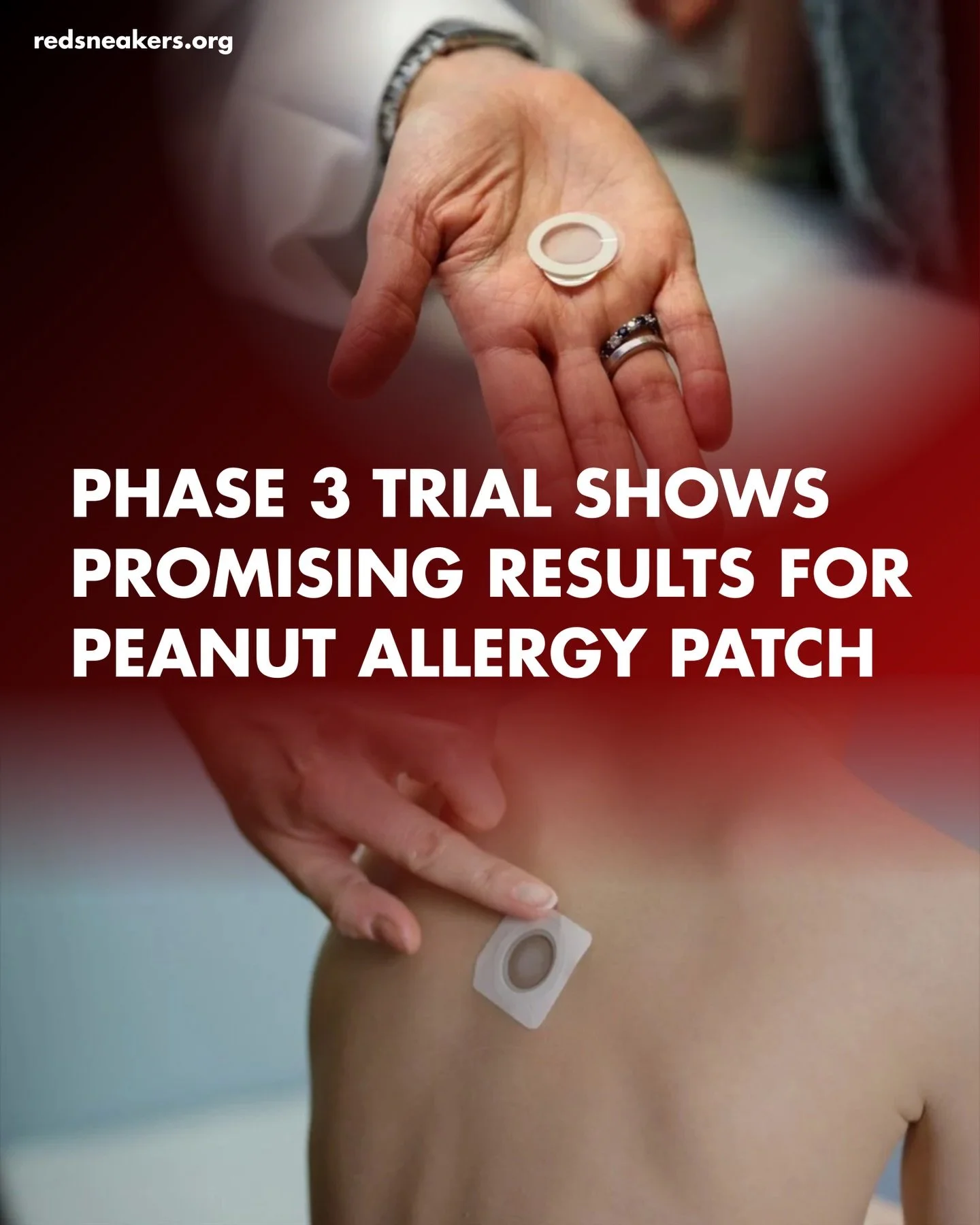📣 Major peanut allergy research milestone! A pivotal Phase 3 VITESSE clinical trial just reported positive topline results for the VIASKIN&reg; Peanut Patch &mdash; an epicutaneous immunotherapy (skin patch) designed to desensitize the immune system