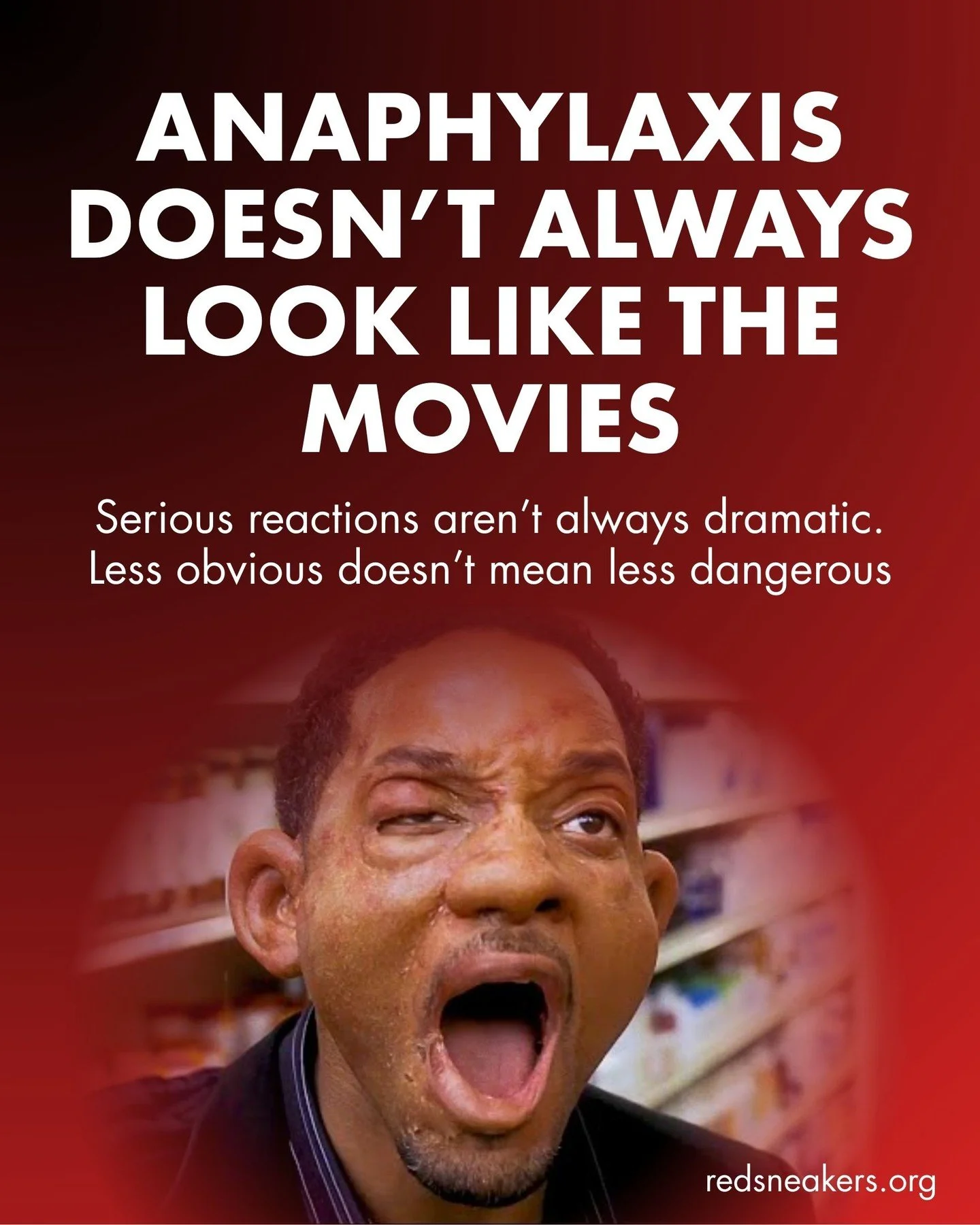 When most people picture a severe allergic reaction, they imagine dramatic symptoms&mdash;swollen faces, gasping for air, full-body hives, or collapsing to the ground. While these are all possible symptoms, anaphylaxis doesn&rsquo;t always look that 