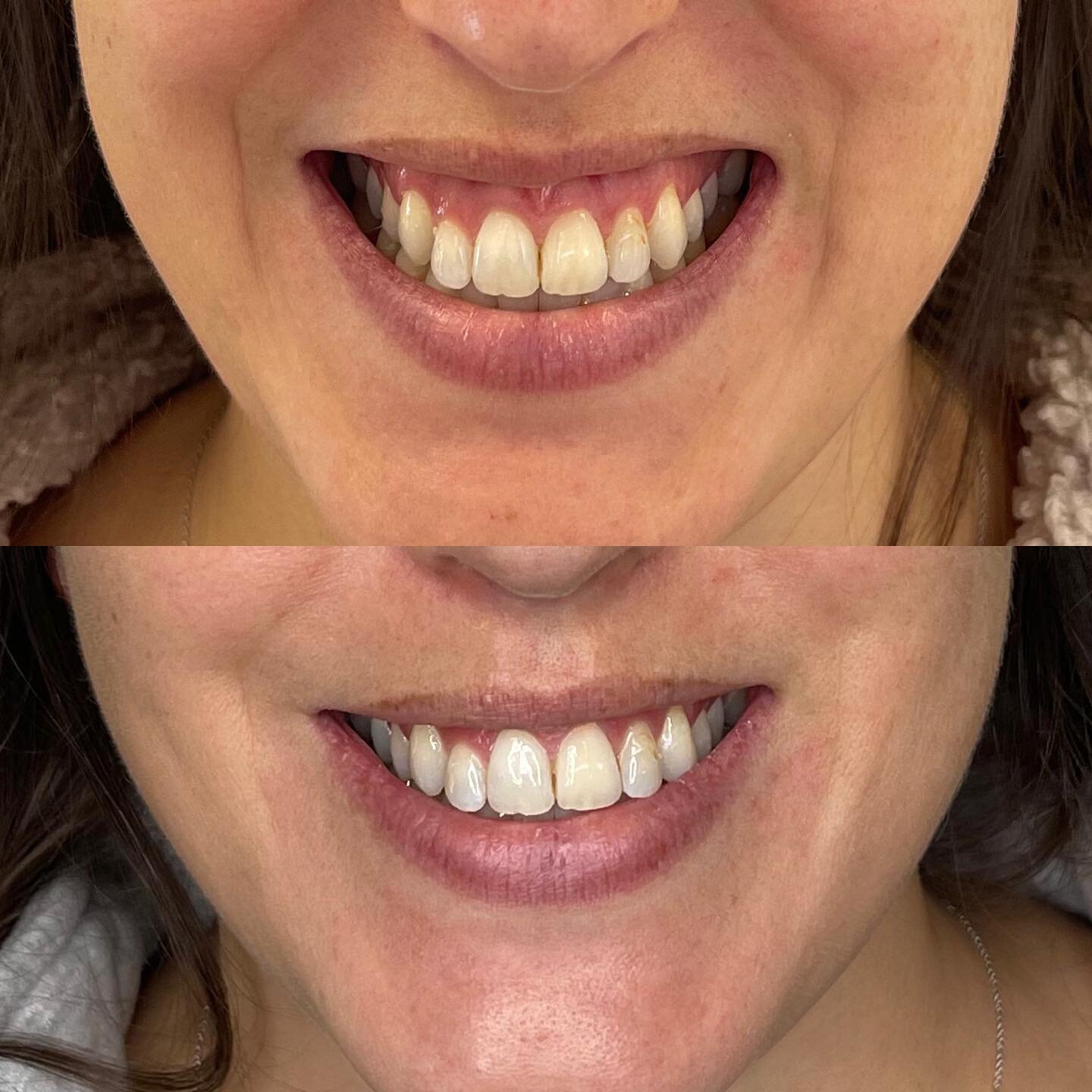 gummy smile correction w/ @botoxcosmetic 🦄