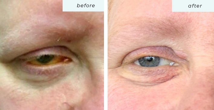 Can Intense Pulsed Light Therapy Treat Dry Eye?