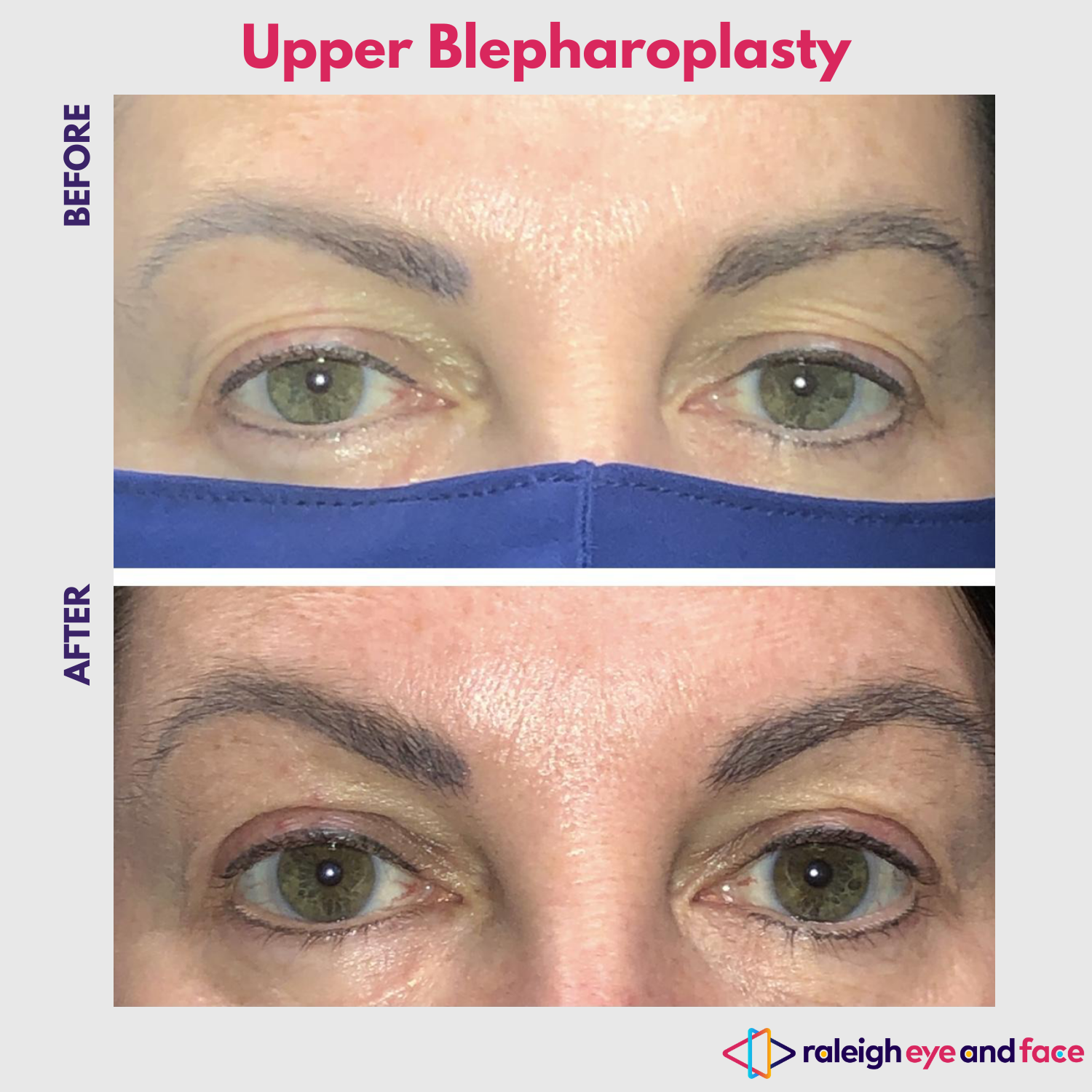 Upper Eyelid Surgery Raleigh Blepharoplasty Raleigh Eye And Face