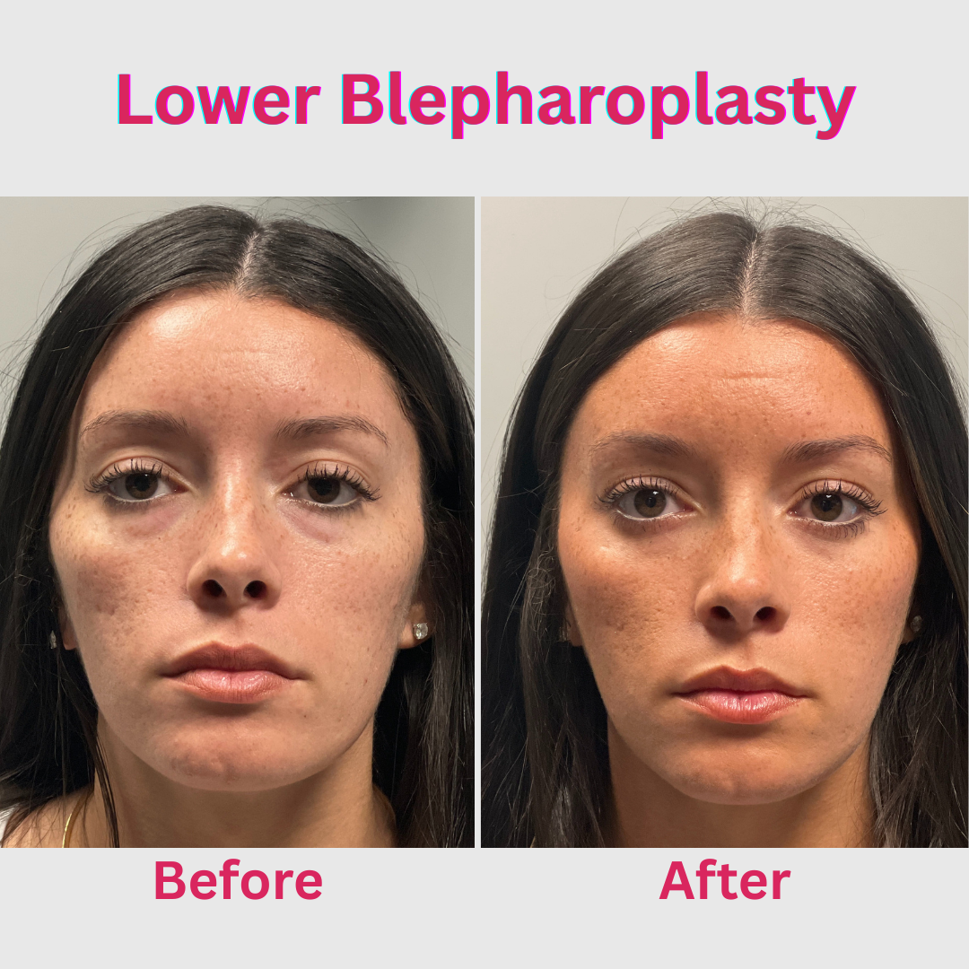 Before and after lower blepharoplasty in a younger patient showing natural improvement of under eye bags