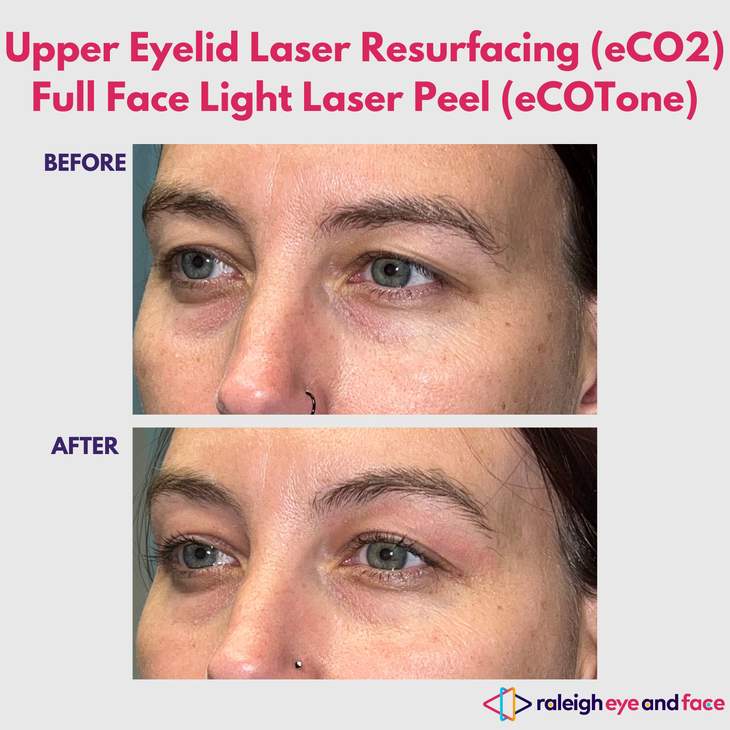 Laser Resurfacing Before and After Gallery — Raleigh Eye and Face