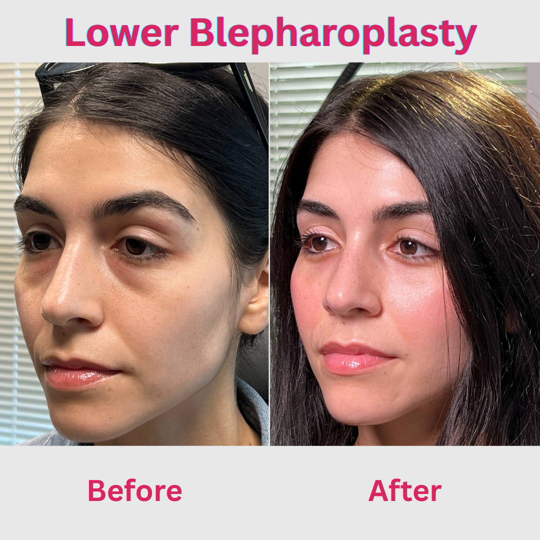 Lower Blepharoplasty in Raleigh, NC by Pradeep Mettu, MD
