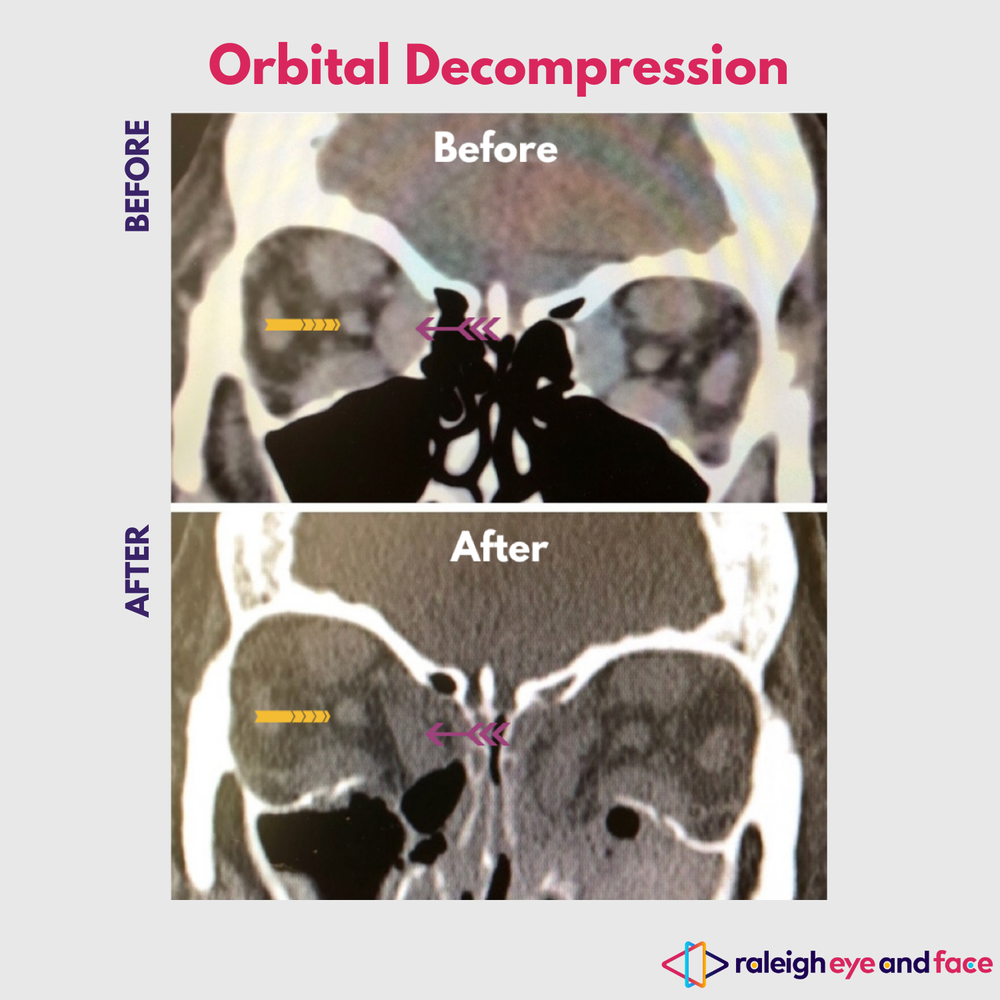 Thyroid Eye Disease Treatment Raleigh, NC — Raleigh Eye and Face