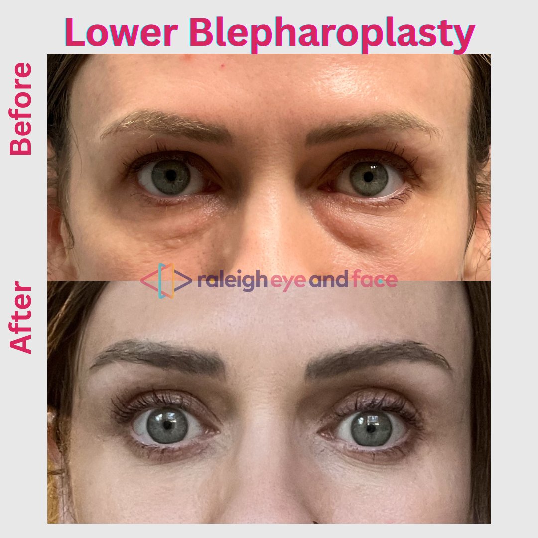 Lower Blepharoplasty 22.png