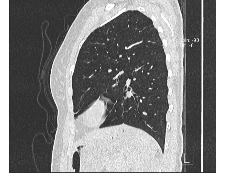 All the lung images are from a AATD patient