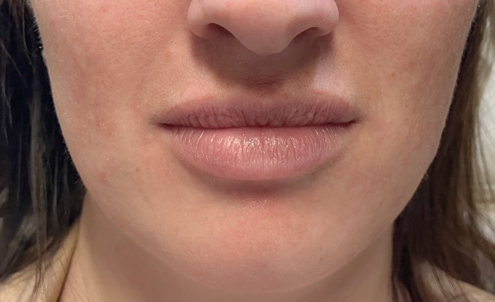 HAAN Aesthetic Medicine_Bozeman_Results-Lip Chin Before.jpg