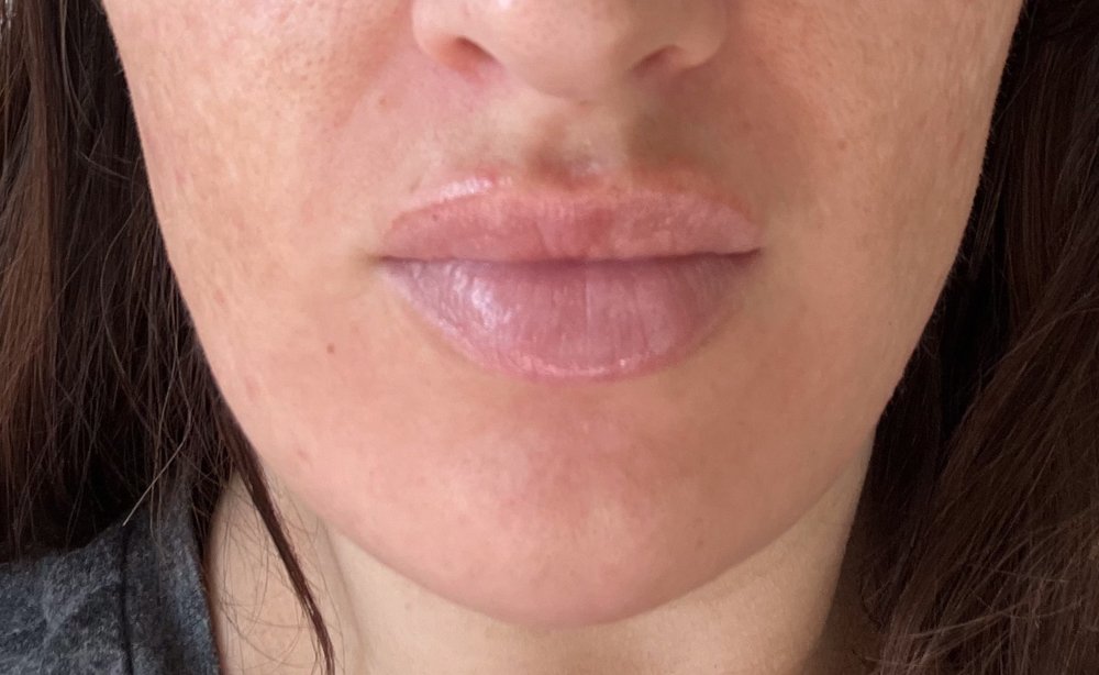 HAAN Aesthetic Medicine_Bozeman_Results-Lip Chin After.jpg