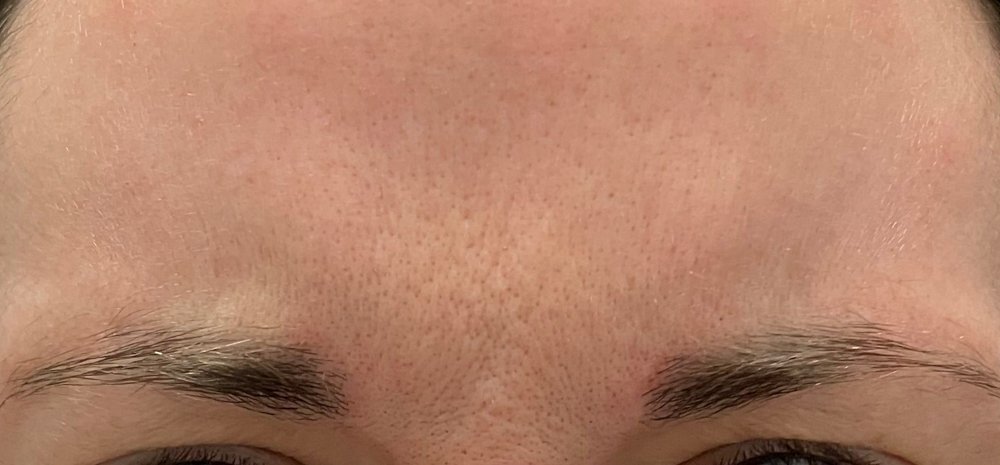 HAAN Aesthetic Medicine_Bozeman_Results Botox After.jpg