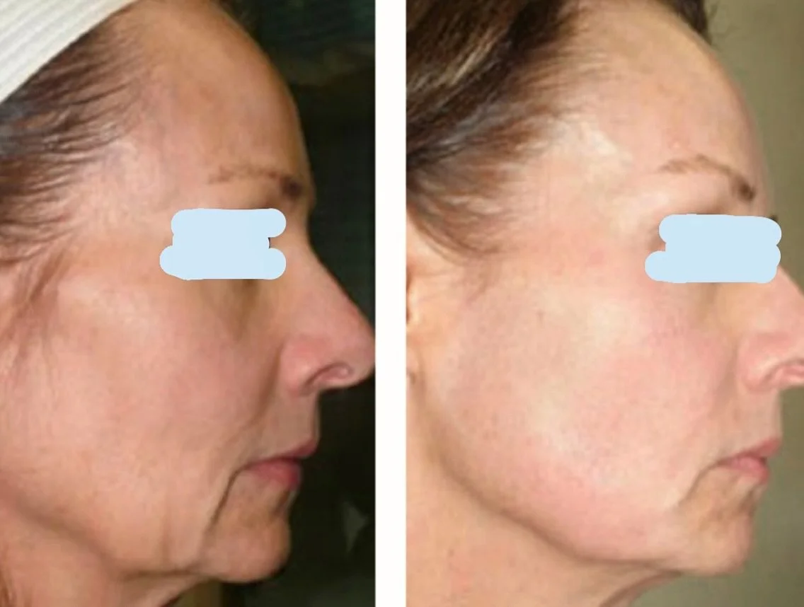 Amazing HIFU treatment⁣ results 🙌🏻 HIFU is our non-surgical facelift perfect for sagging skin⁣ with no down time 👏👏⁣
⁣
Book your complimentary consultation NOW via the #linkinbio⁣⁣⁣ or call 0493 863 316 ⚡️⁣
⁣⁣⁣⁣⁣
⁣⁣⁣⁣⁣⁣
⁣⁣⁣⁣⁣⁣
⁣⁣⁣
⁣⁣⁣⁣⁣
#beachesb
