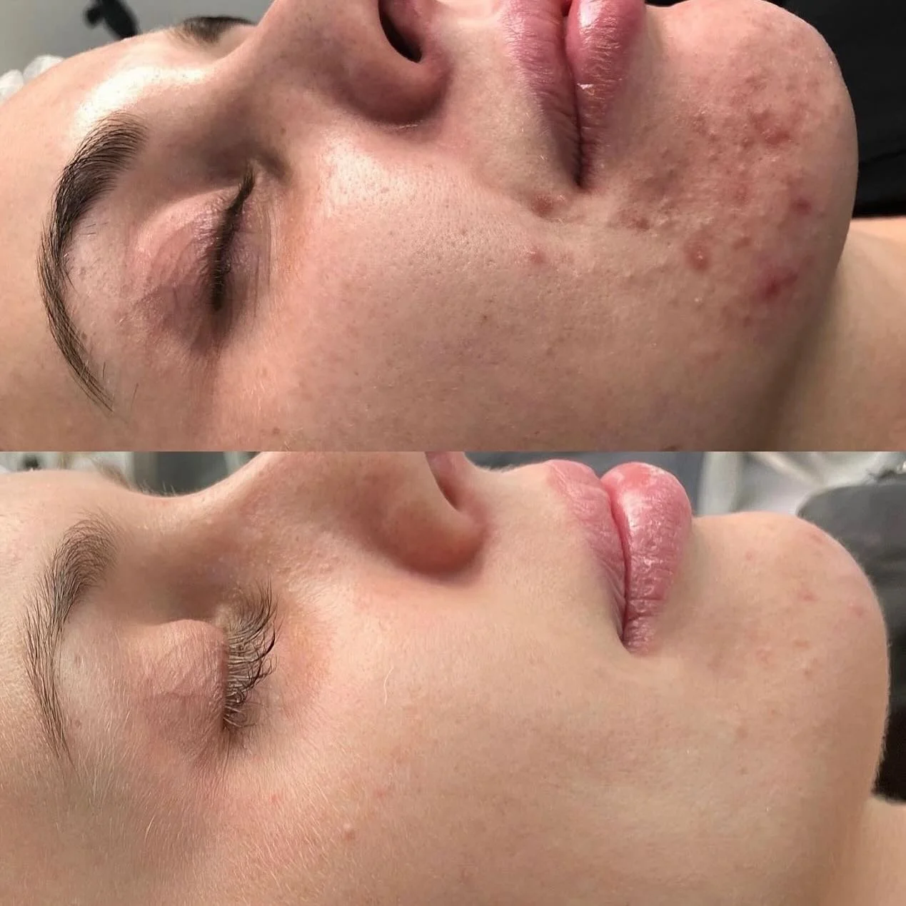 Incredible before &amp; after results from Dermalux Flex LED light treatments!⁣
⁣
By following a course of in-clinic treatments including Dermalux LED combined with a prescribed at-home skincare regime, here are just some of the skin-enhancing benefi