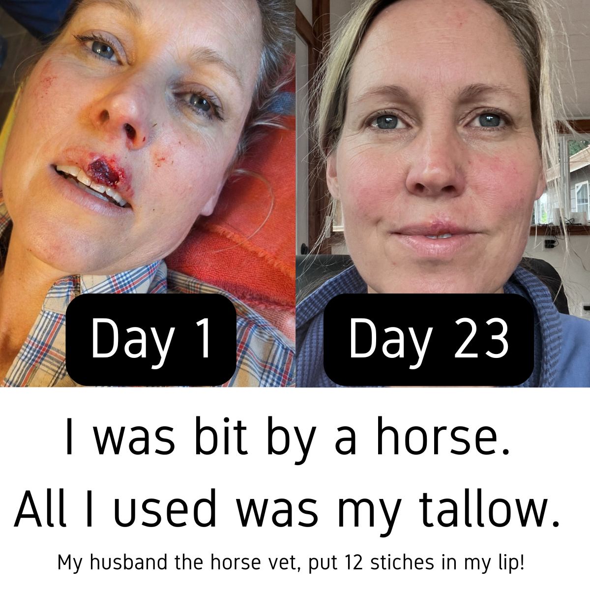 I was bit by a horse. All I used was my tallow..png
