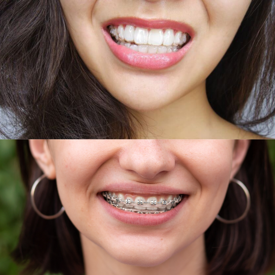 Invisalign Vs Frenos