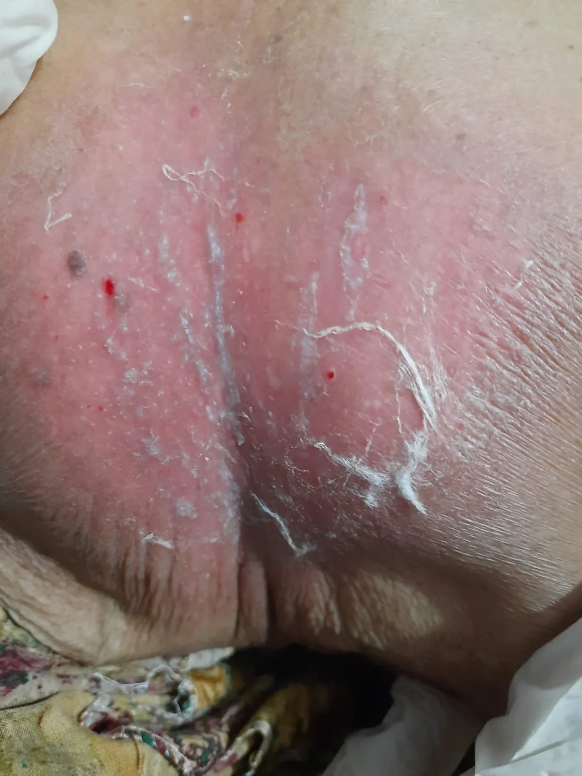 24 hours after an indicated remedy
