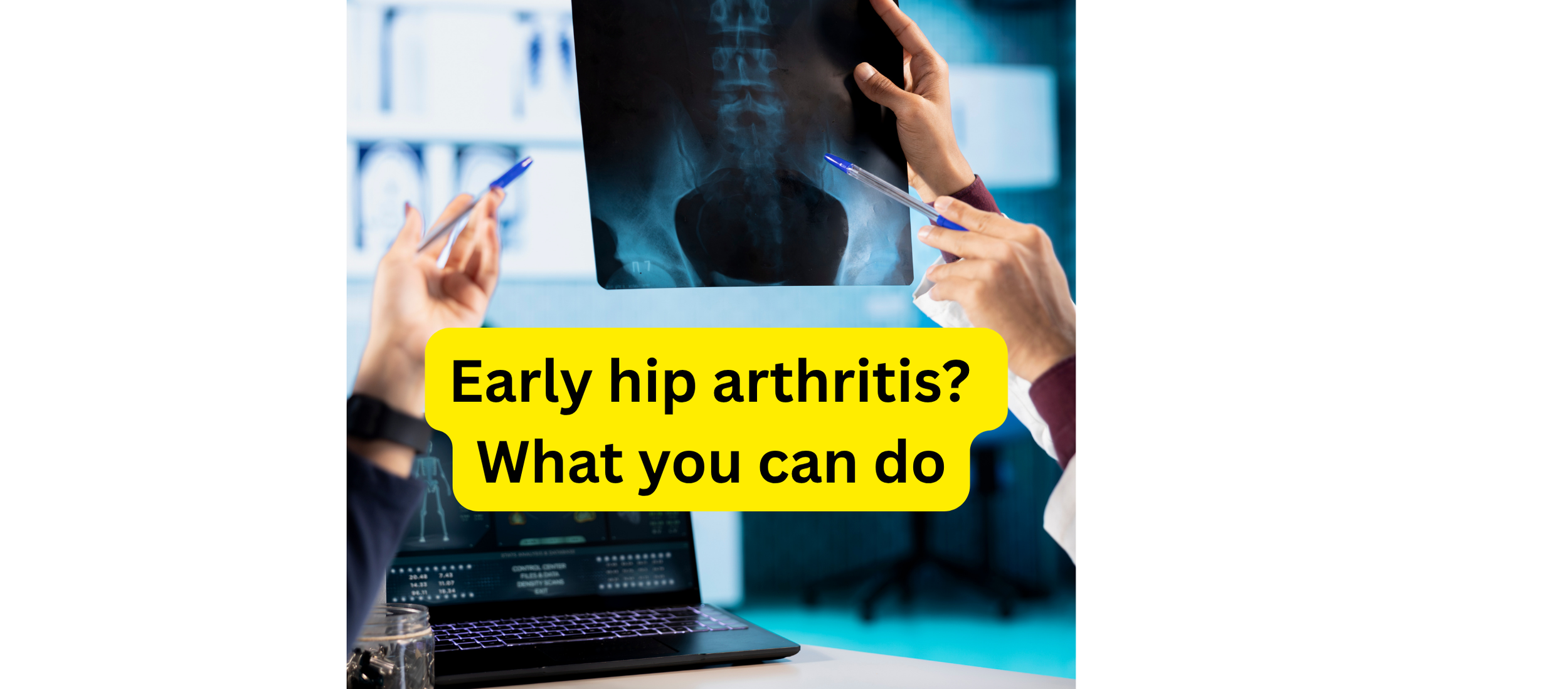 Early hip arthritis? What you can do about it. 