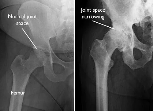 Normal versus Arthritic Hip Xray