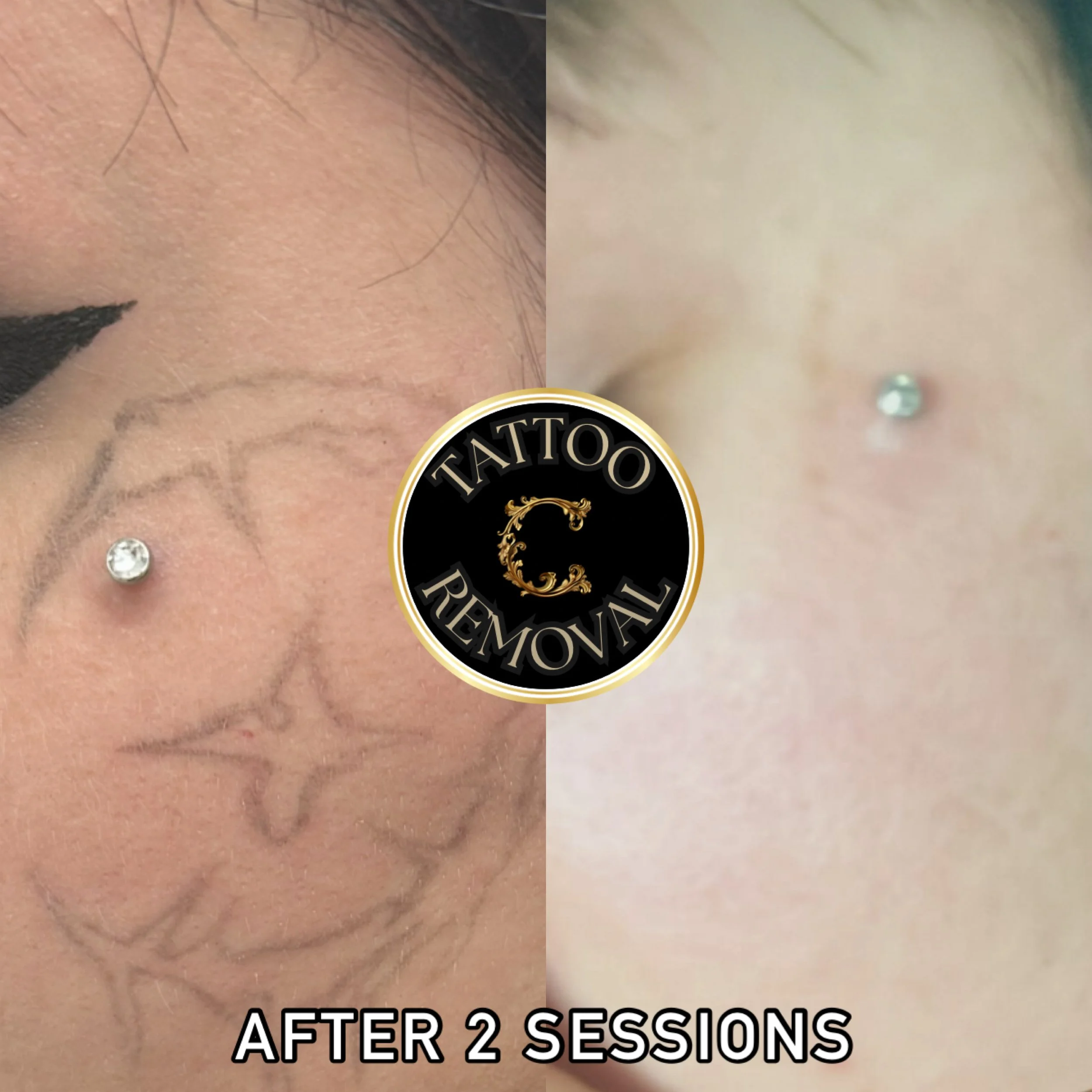 Before and after of laser tattoo removal of face tattoo at Chariot Tattoo and Laser Removal in Boise after just 1 session. 