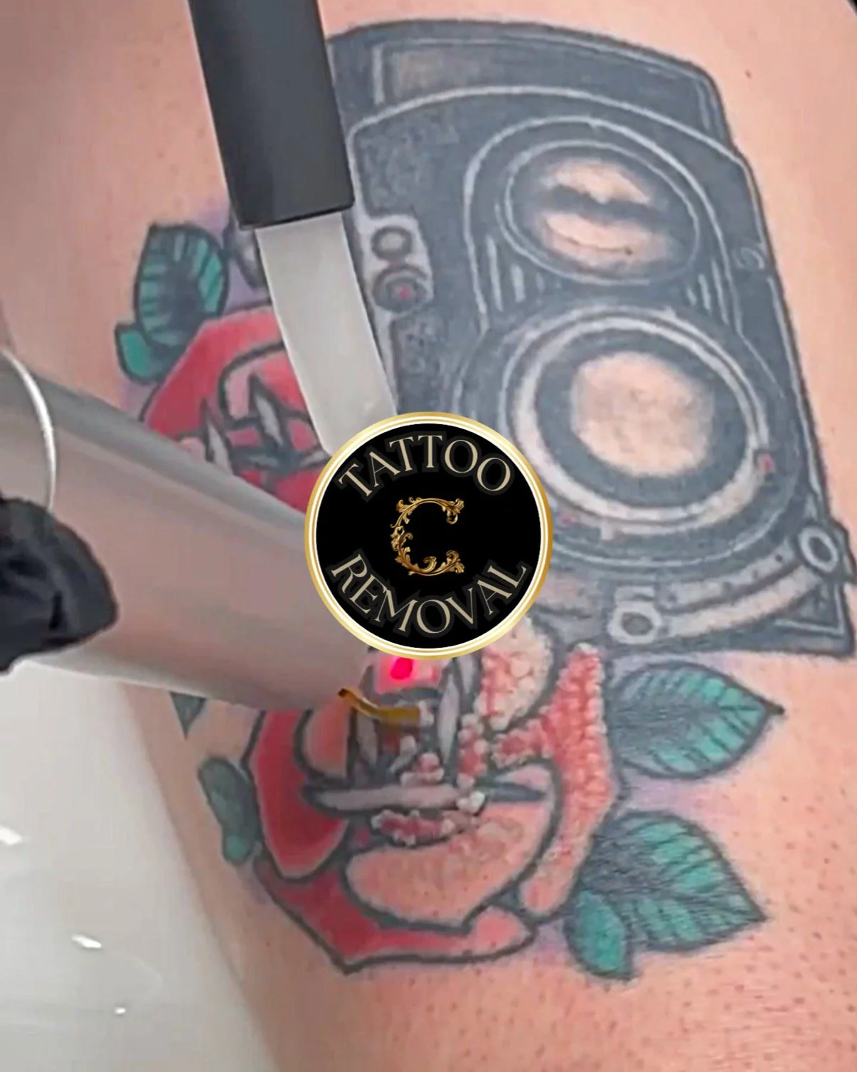 Can all tattoo colors be removed?