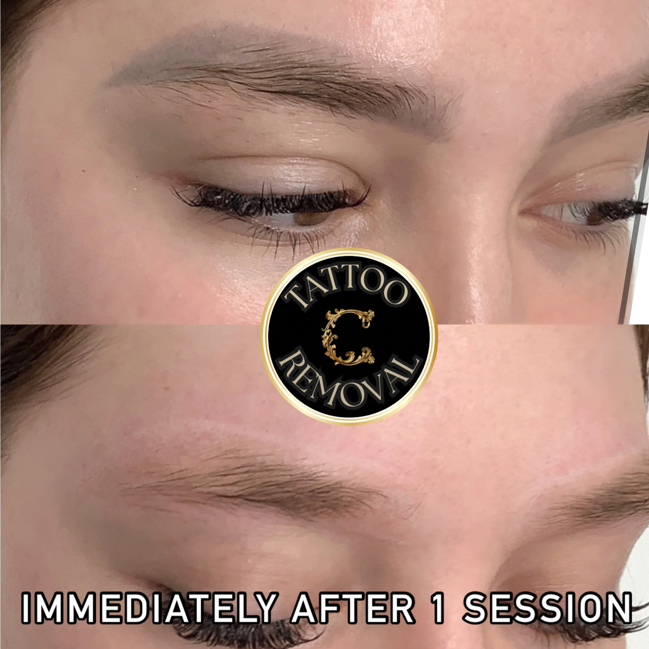 Microblading removal success after just one session, revealing clients true skin tone. 