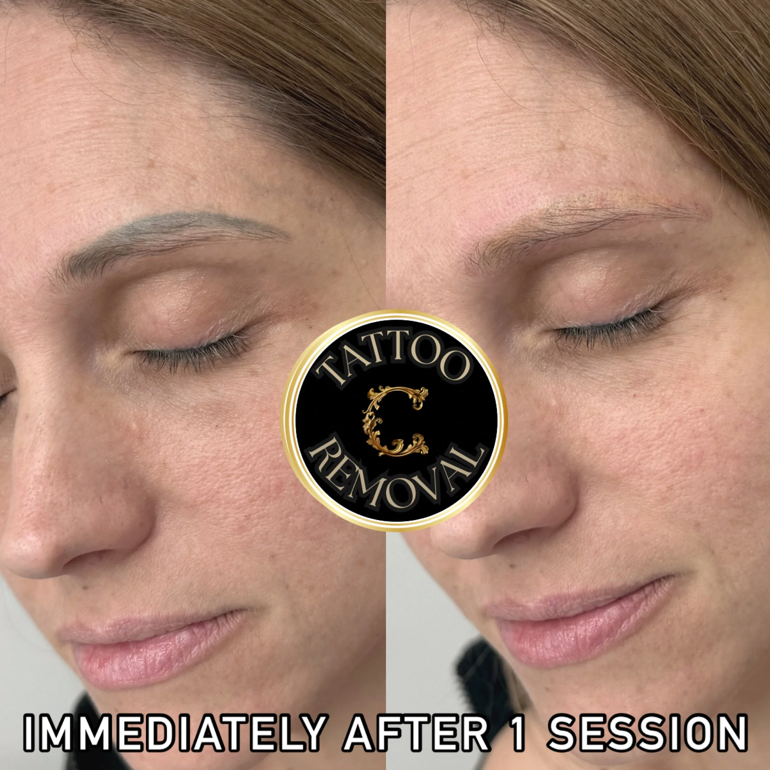 Old microblading that turned gray fully removed and ready for a microblading cover up after successful laser tattoo removal at Chariot Tattoo & Laser in Boise. 