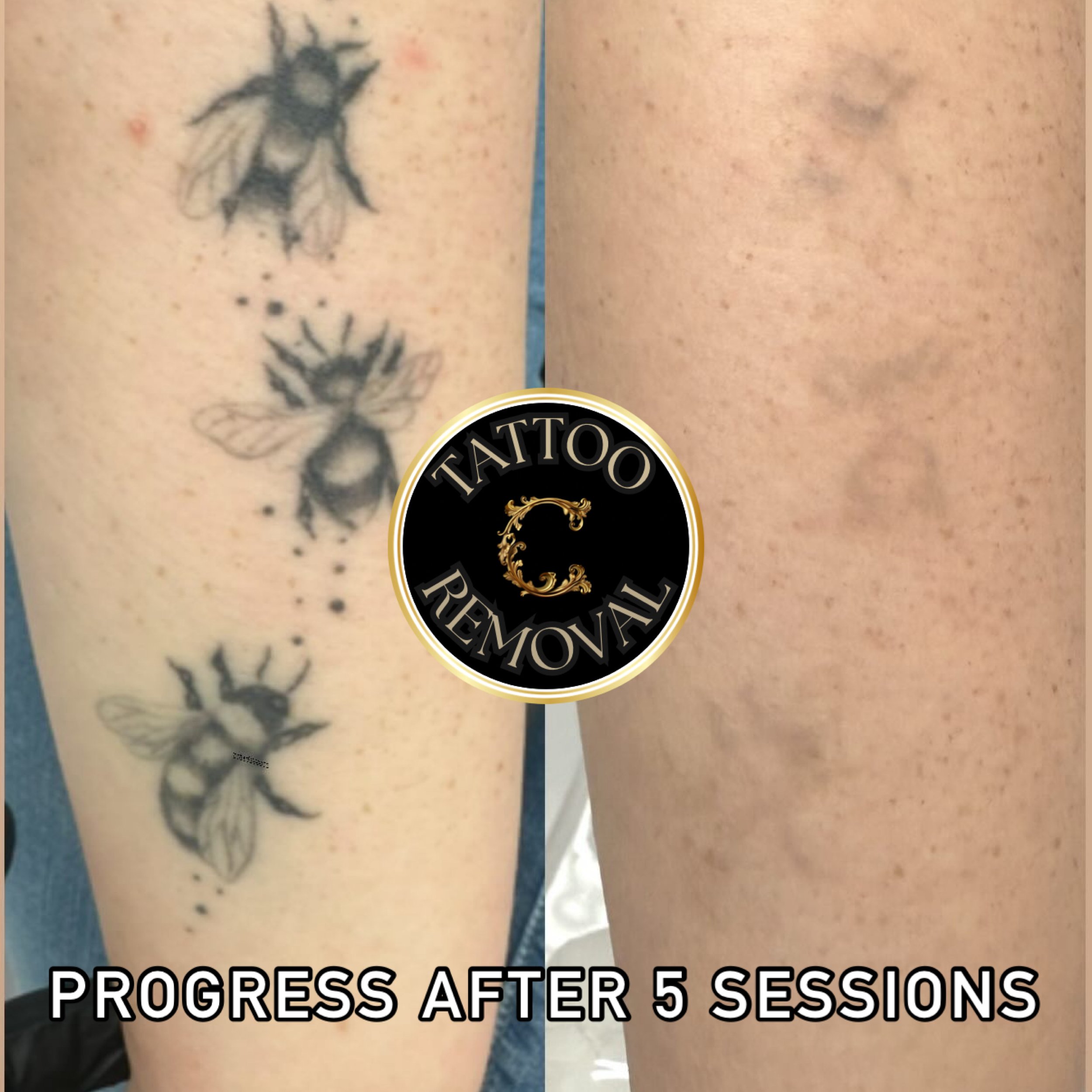 Bumble bee tattoos that have almost entirely disappeared with 5 sessions of laser tattoo removal with the Candela Picoway laser in Boise. 