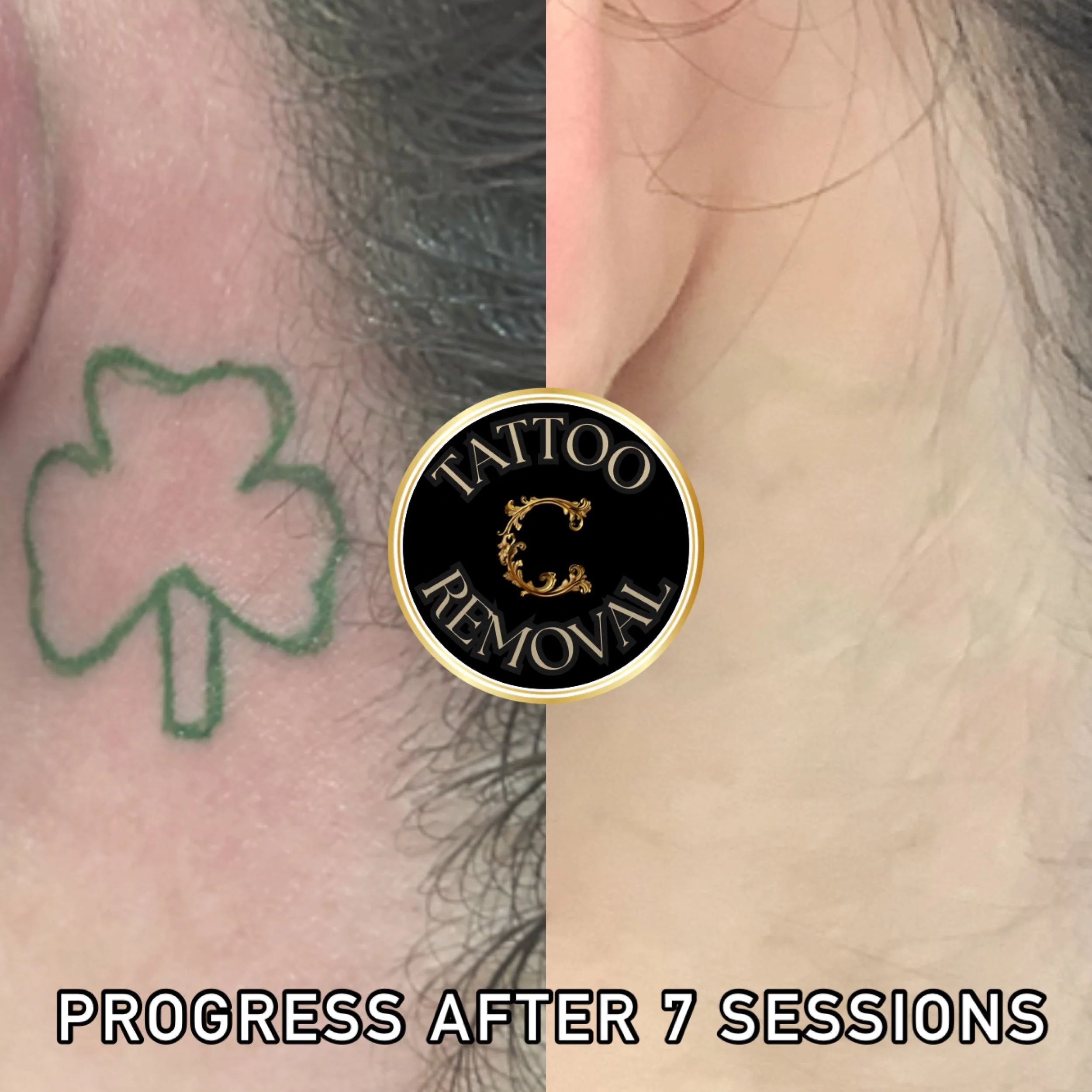Photo update on clover tattoo behind ear that's almost gone from safe and effective laser tattoo removal with picosecond technology. 