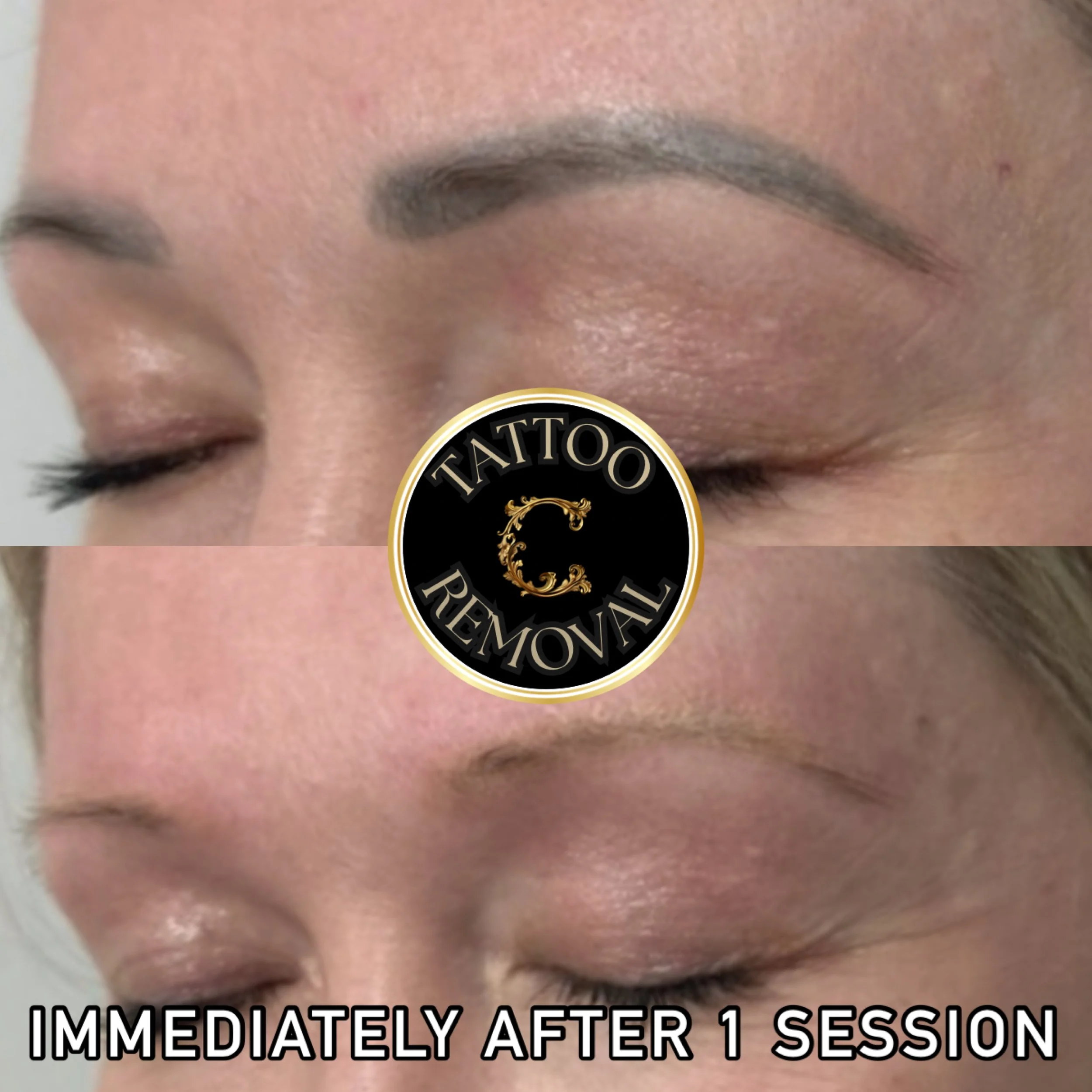 Dark gray microblading successfully removed with one session of tattoo removal at Chariot Tattoo & Laser in Boise, Idaho. 